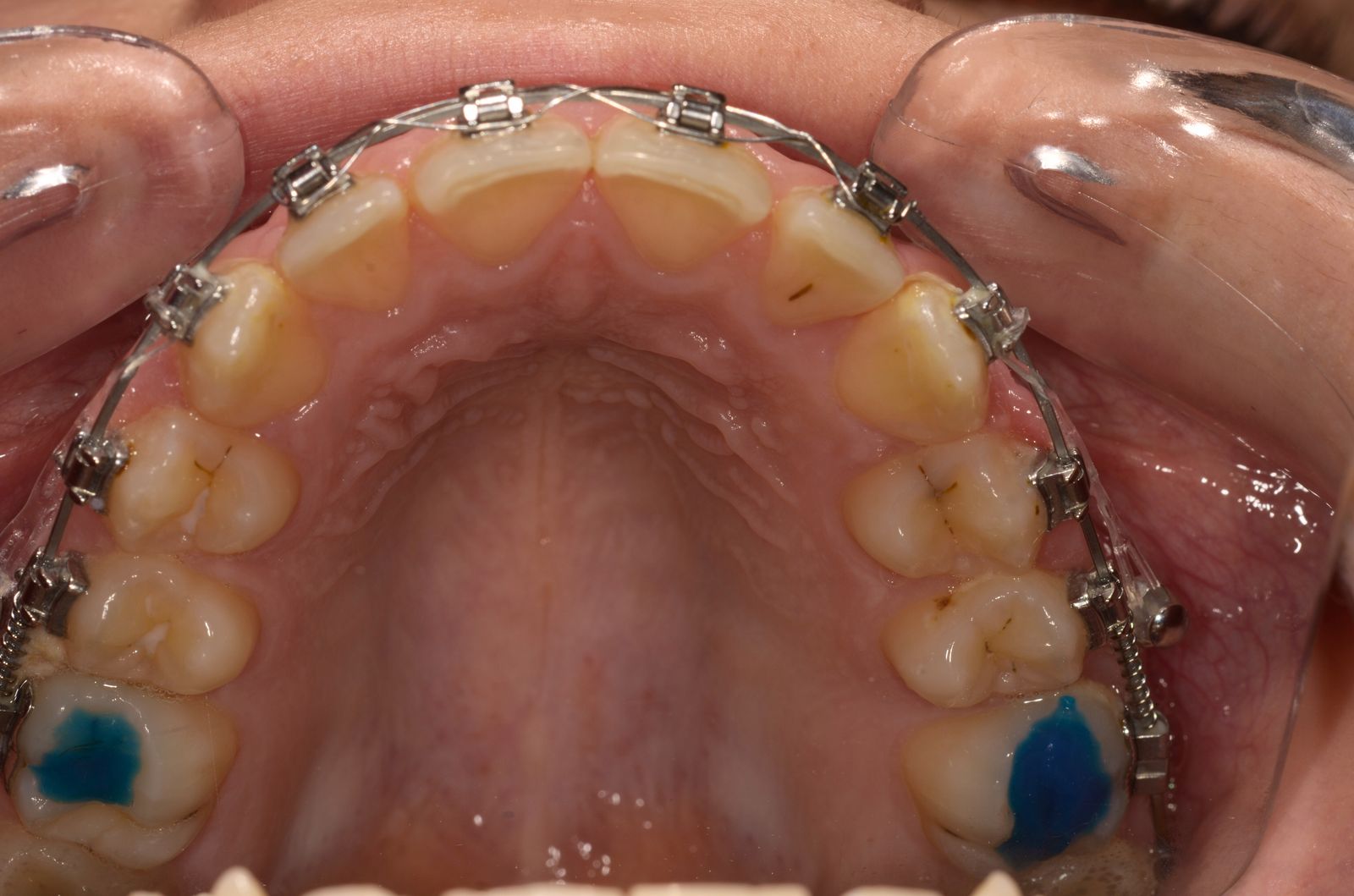 Breketai — atvejis 1