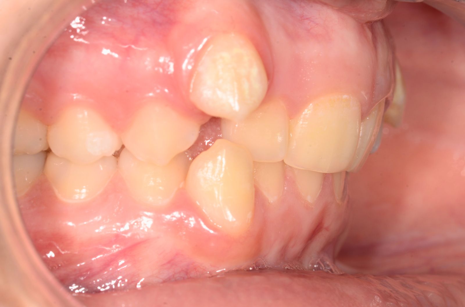 Breketai — atvejis 1