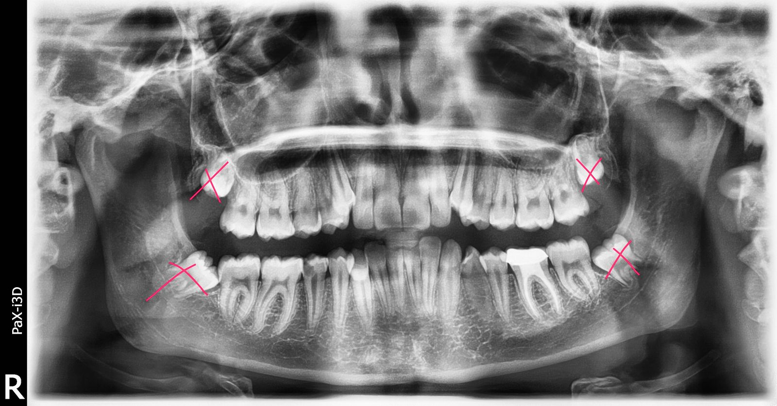 Breketai — atvejis 1
