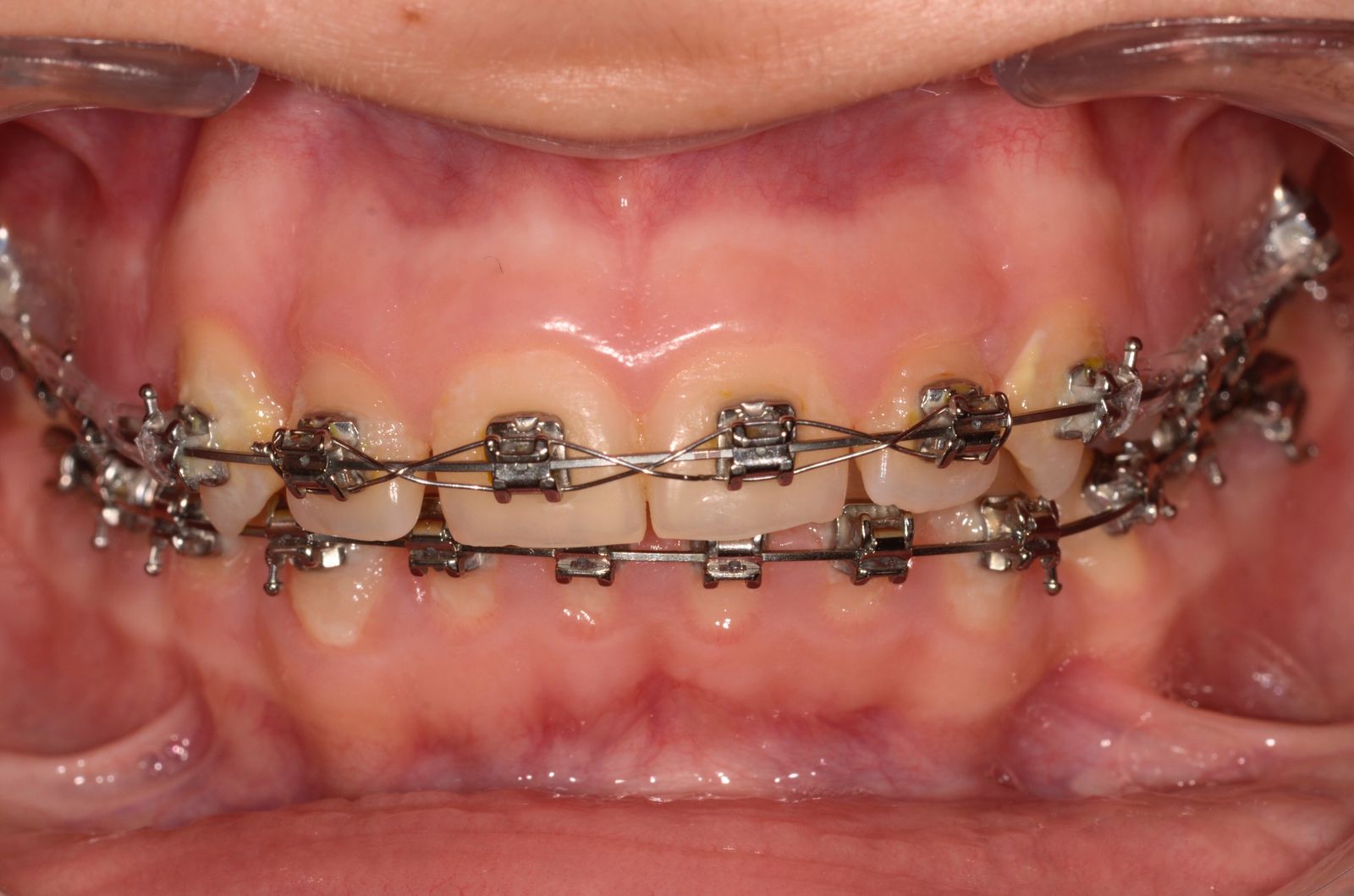 Breketai — atvejis 1