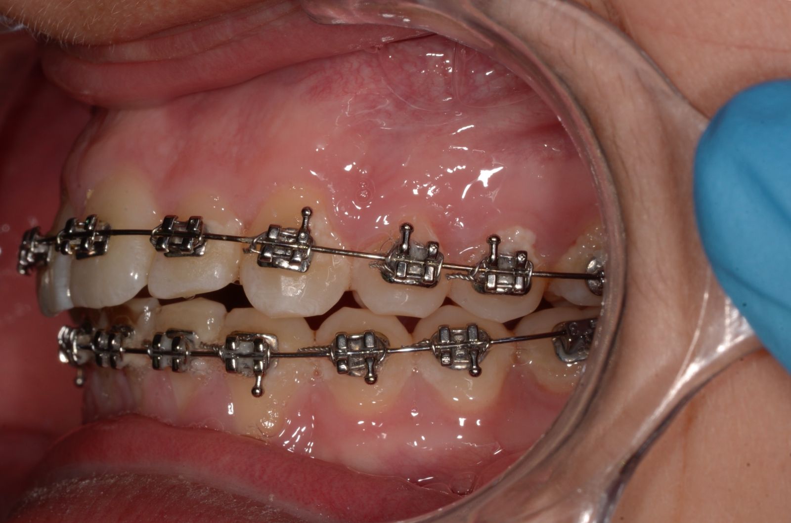 Breketai — atvejis 8