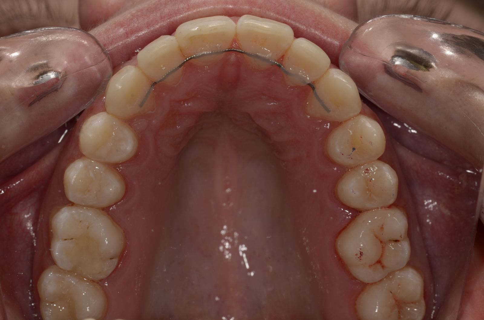 Breketai — atvejis 8