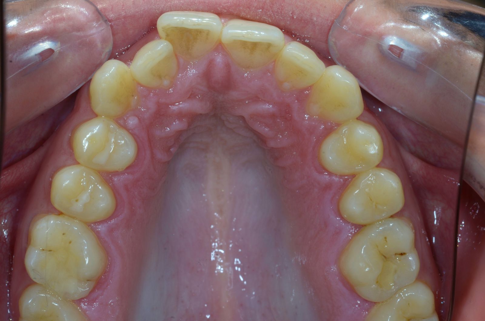 Breketai — atvejis 8