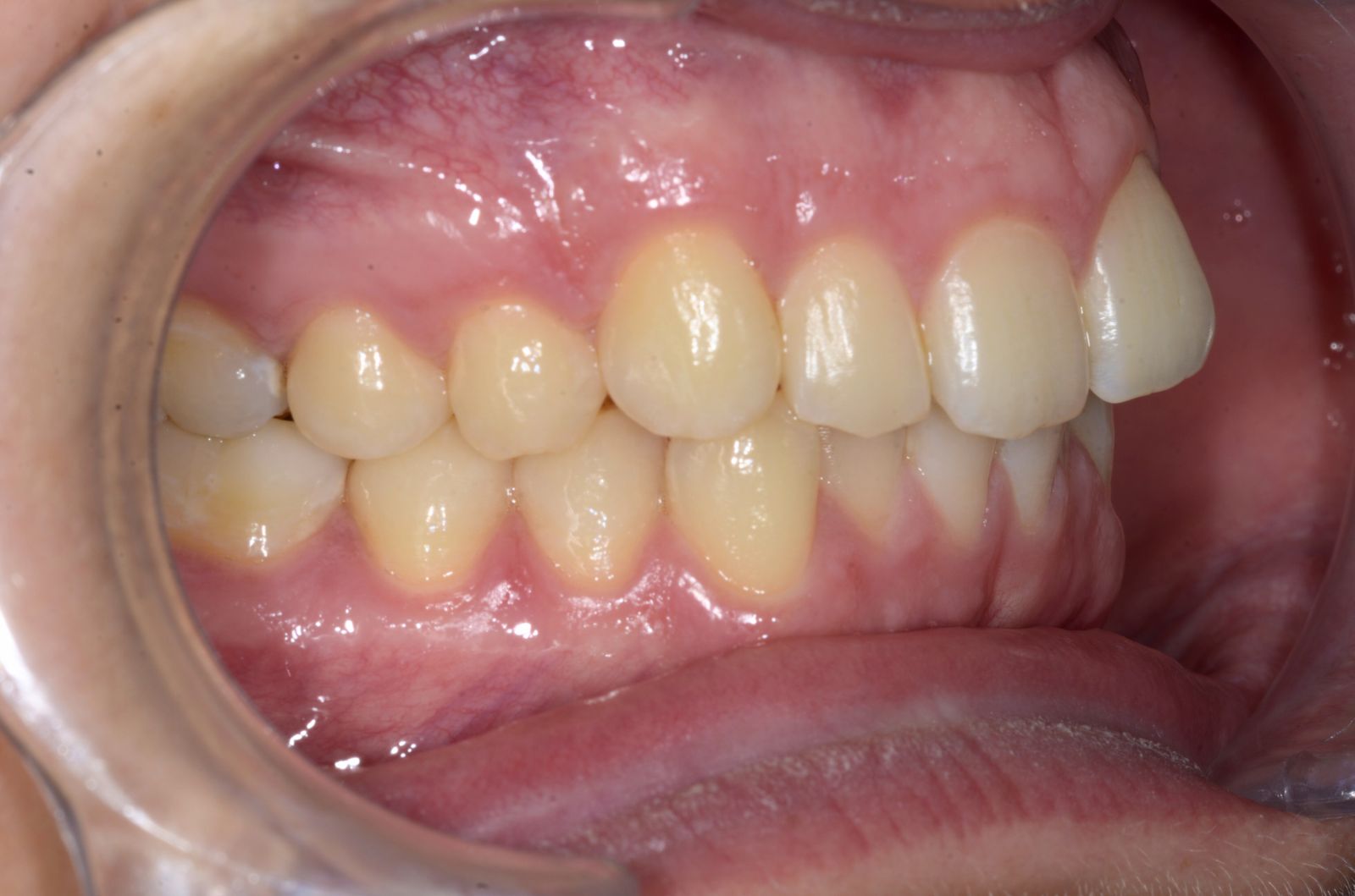 Breketai — atvejis 8