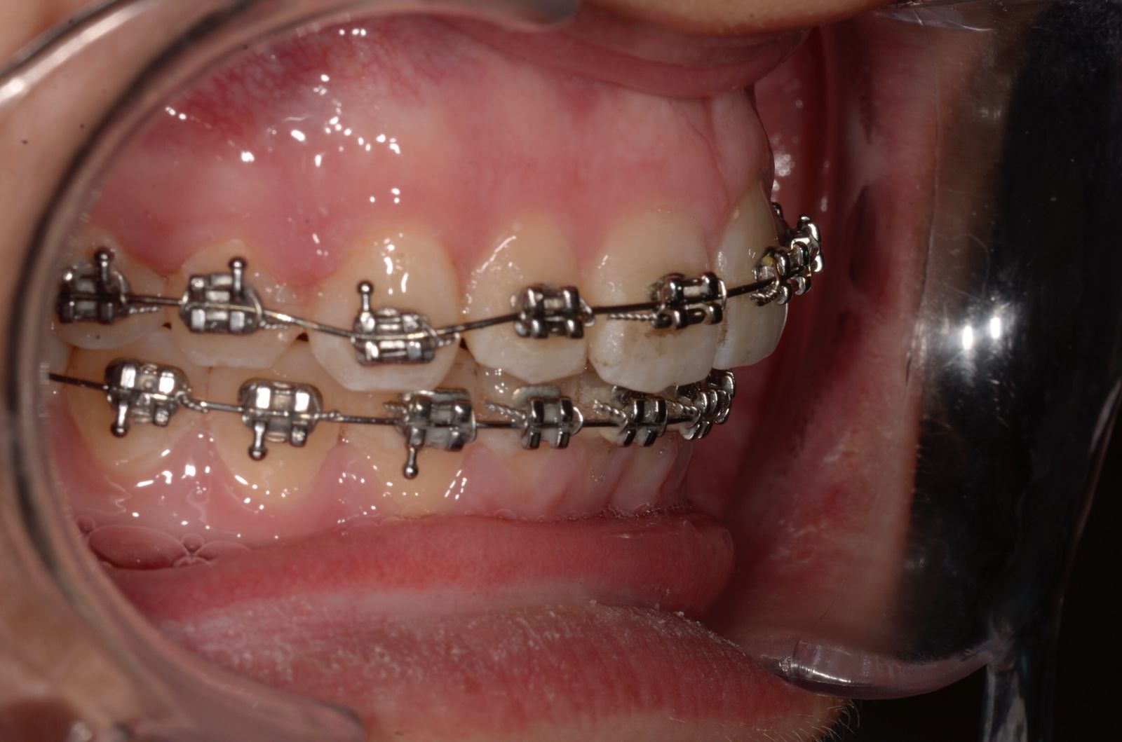 Breketai — atvejis 8