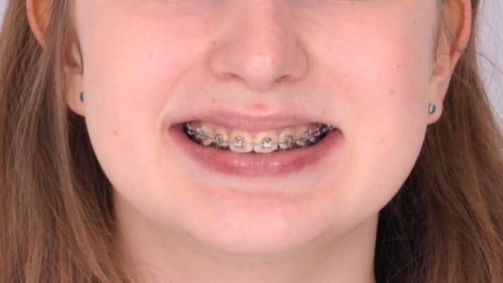 Breketai — atvejis 9