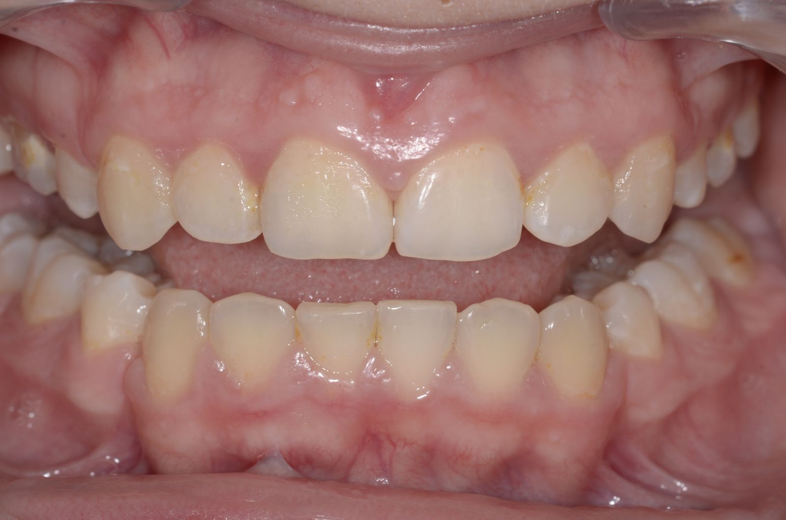 Breketai — atvejis 9