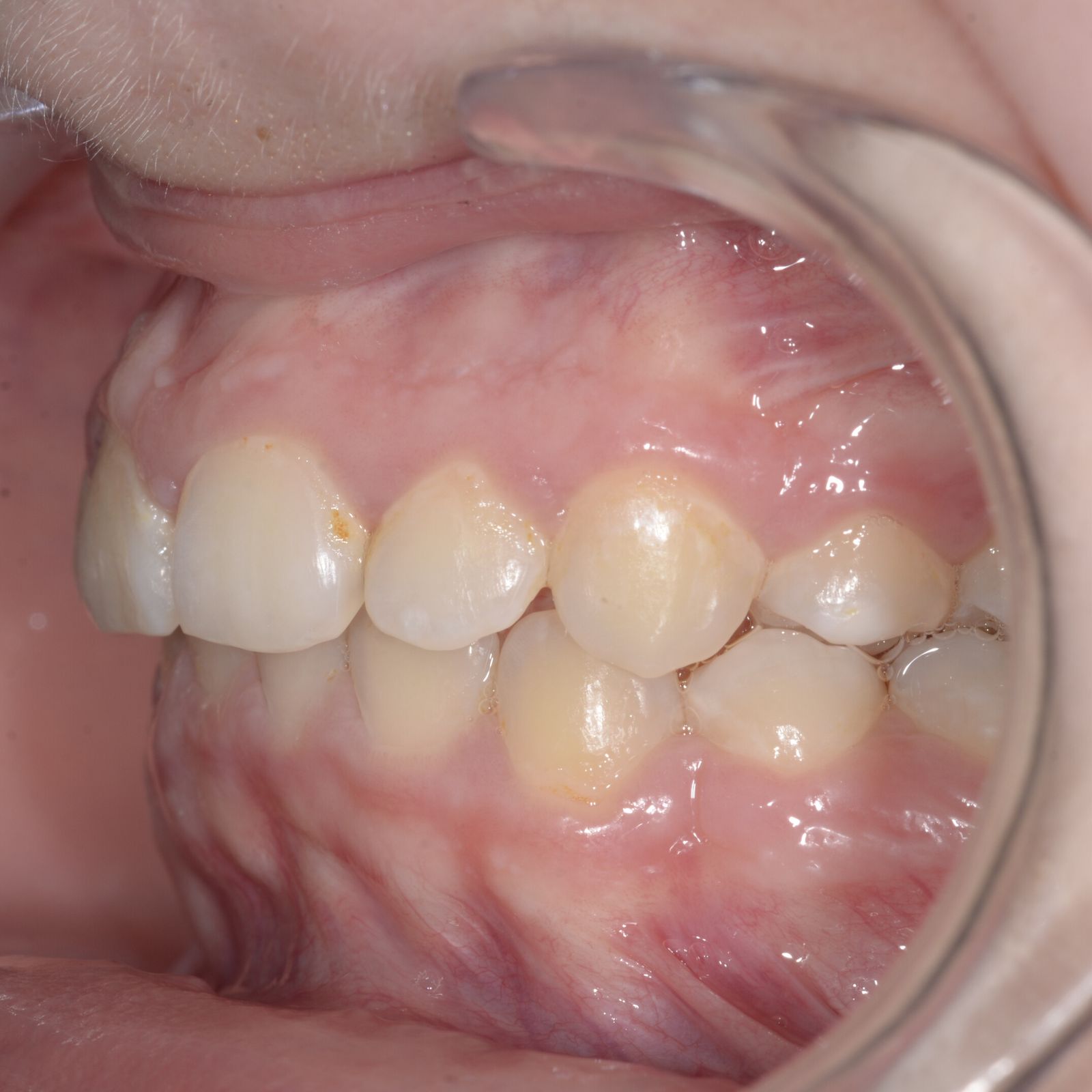 Breketai — atvejis 9