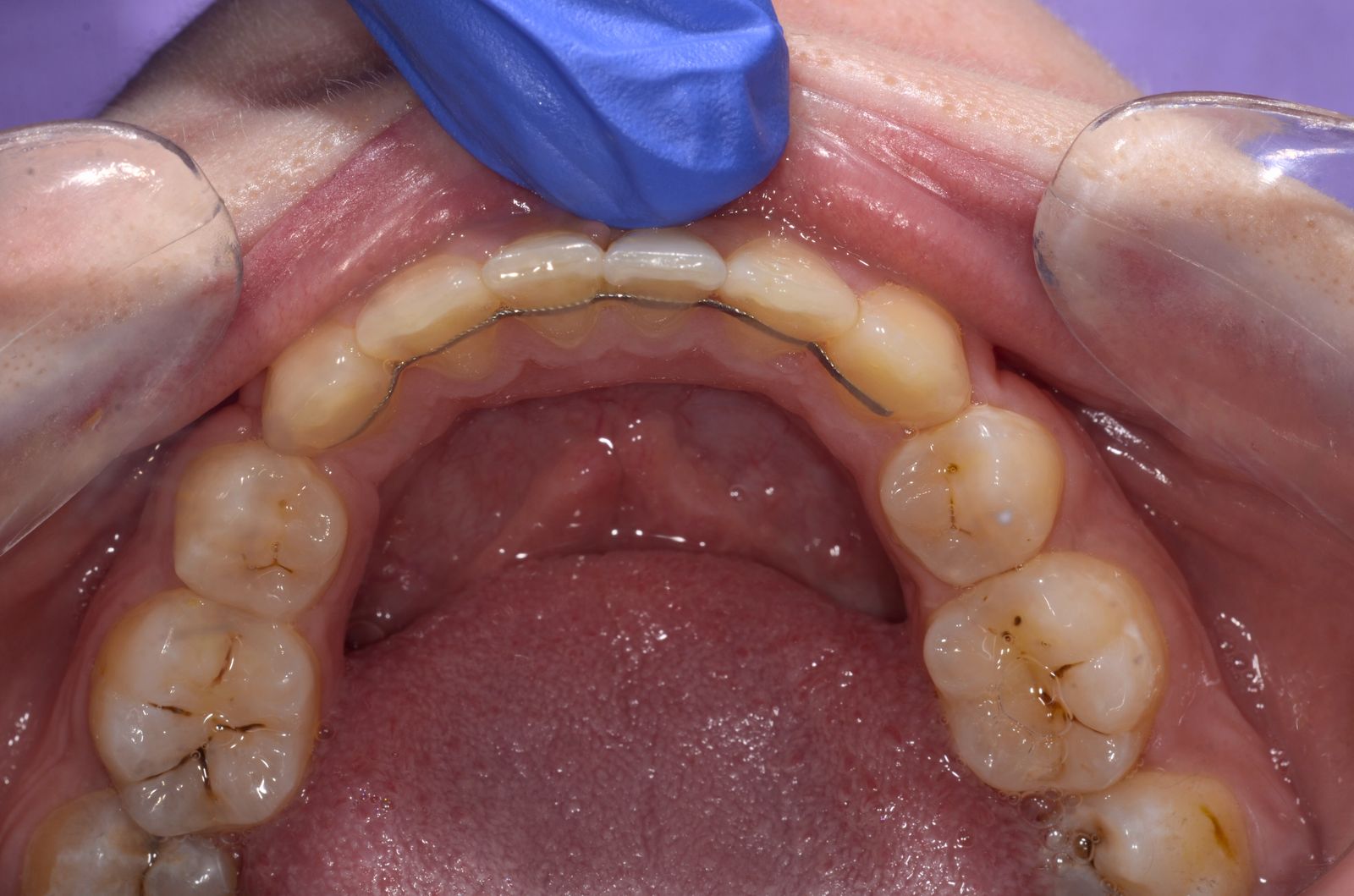 Breketai — atvejis 9