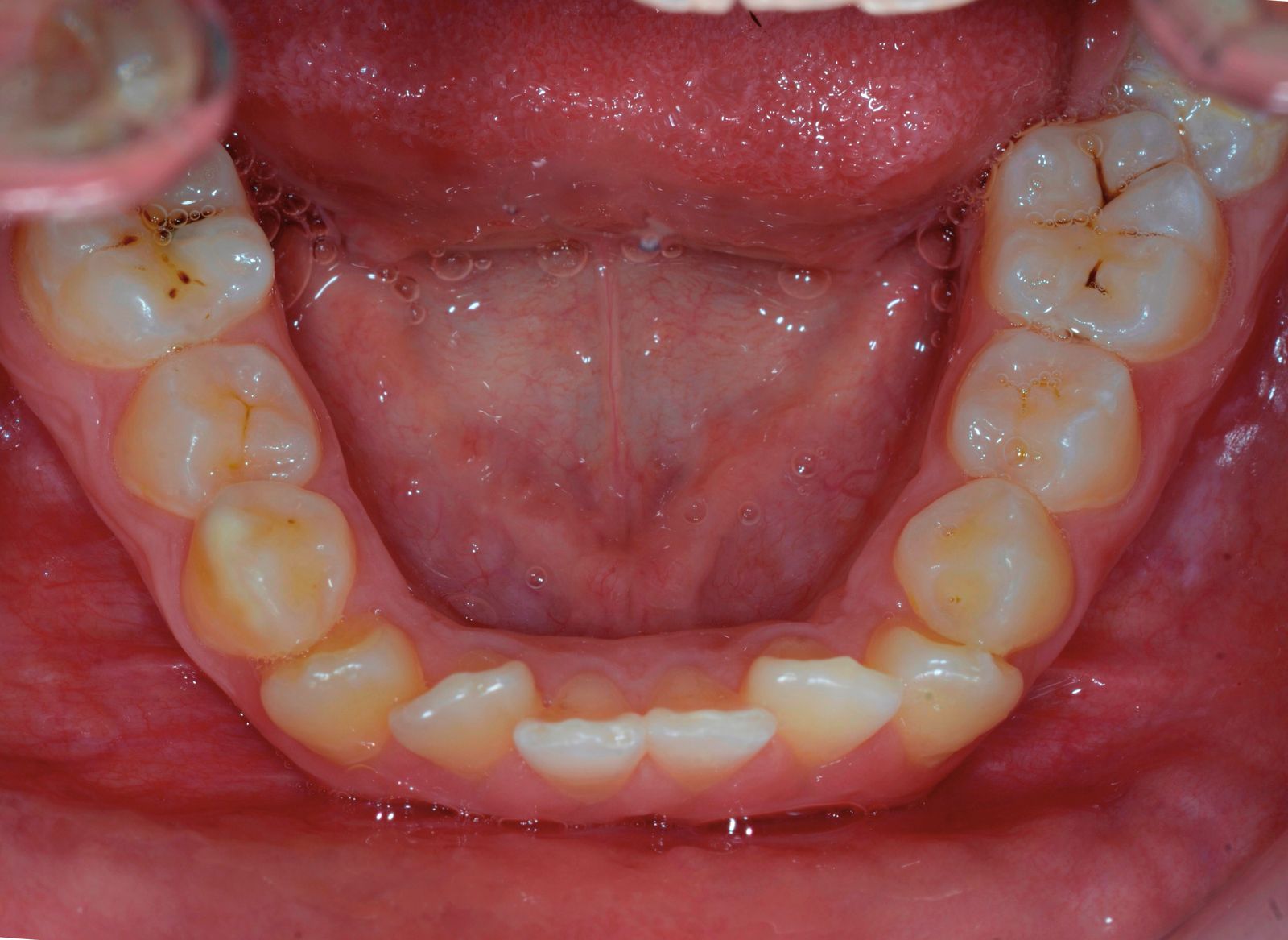 Breketai — atvejis 9