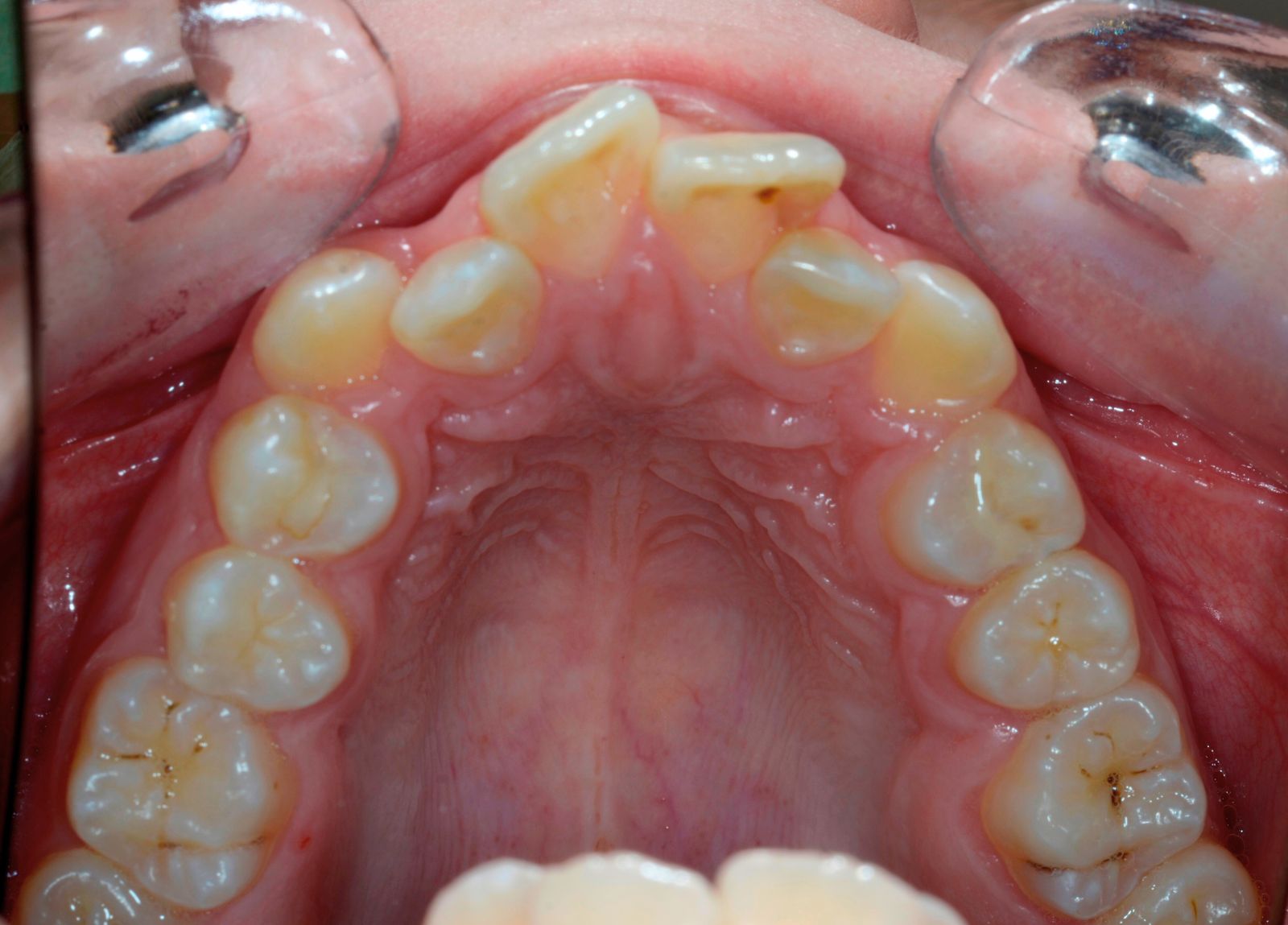 Breketai — atvejis 9