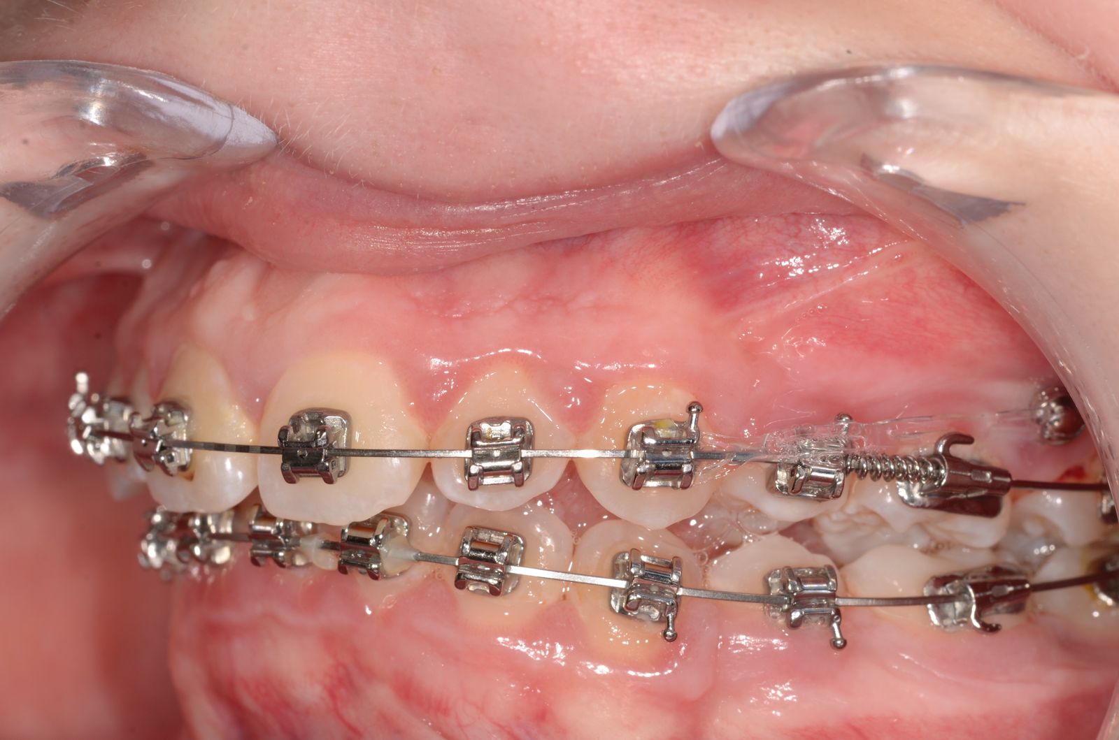 Breketai — atvejis 9