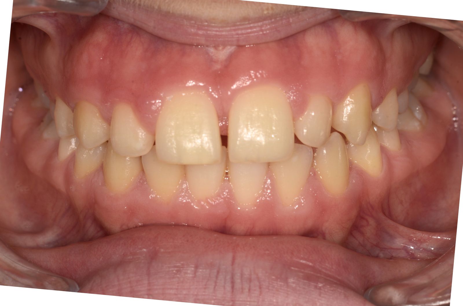 Breketai — atvejis 2