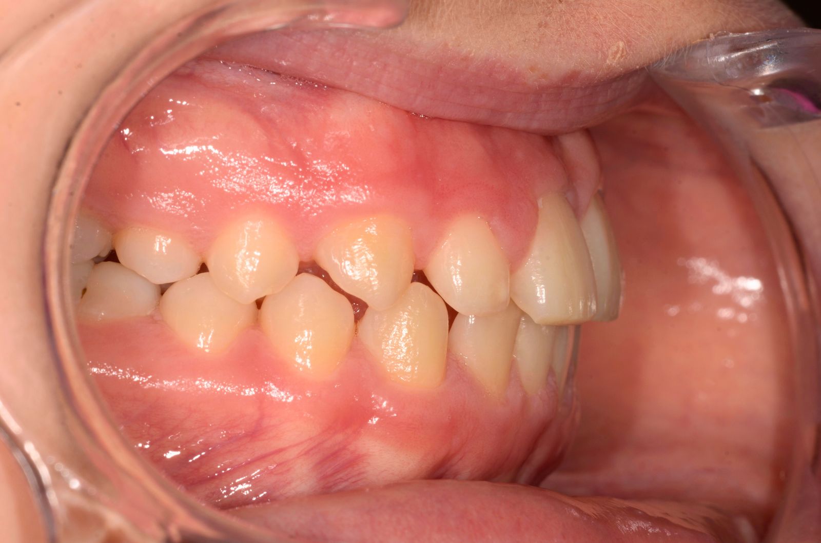 Breketai — atvejis 2