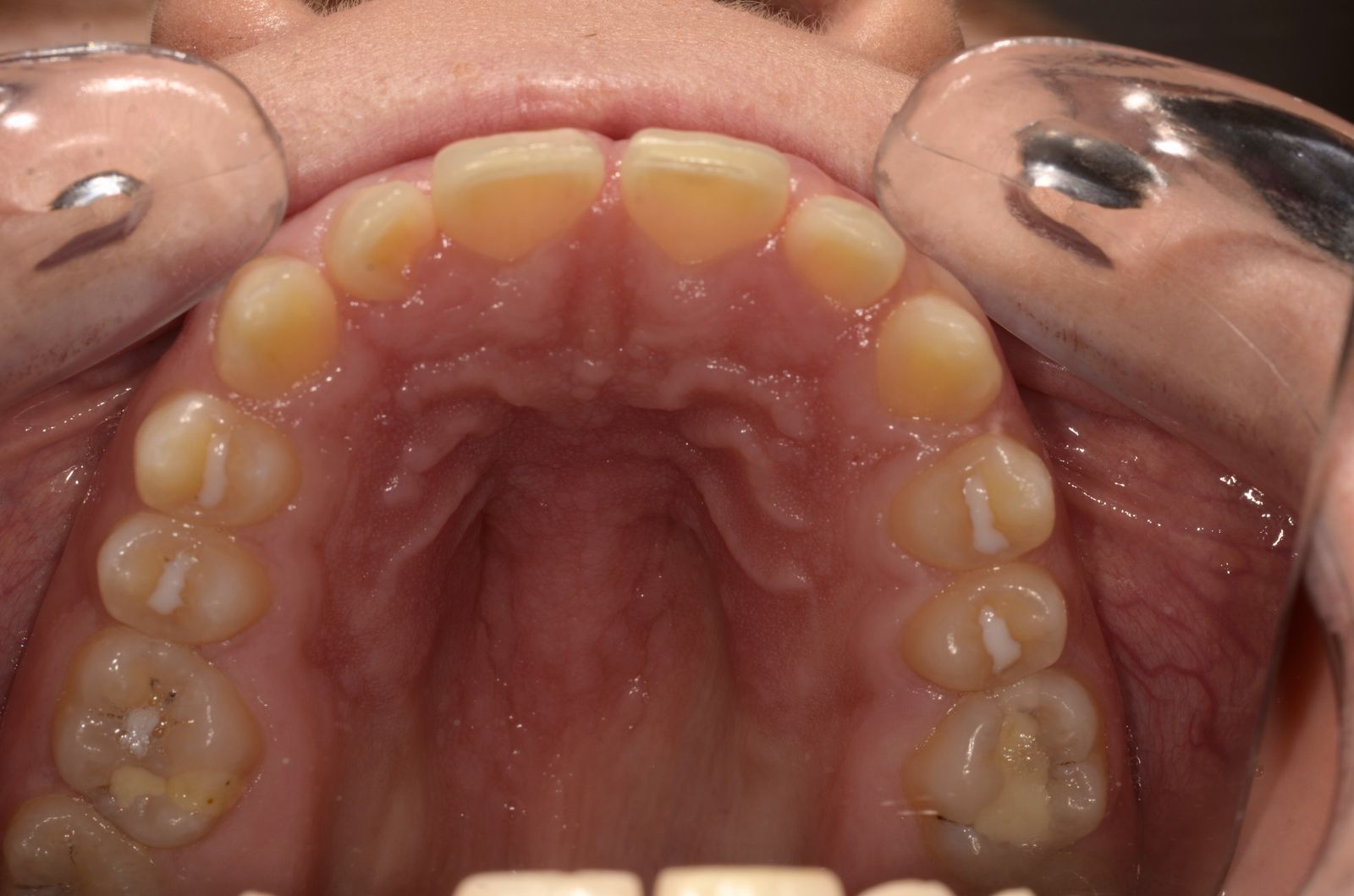 Breketai — atvejis 2