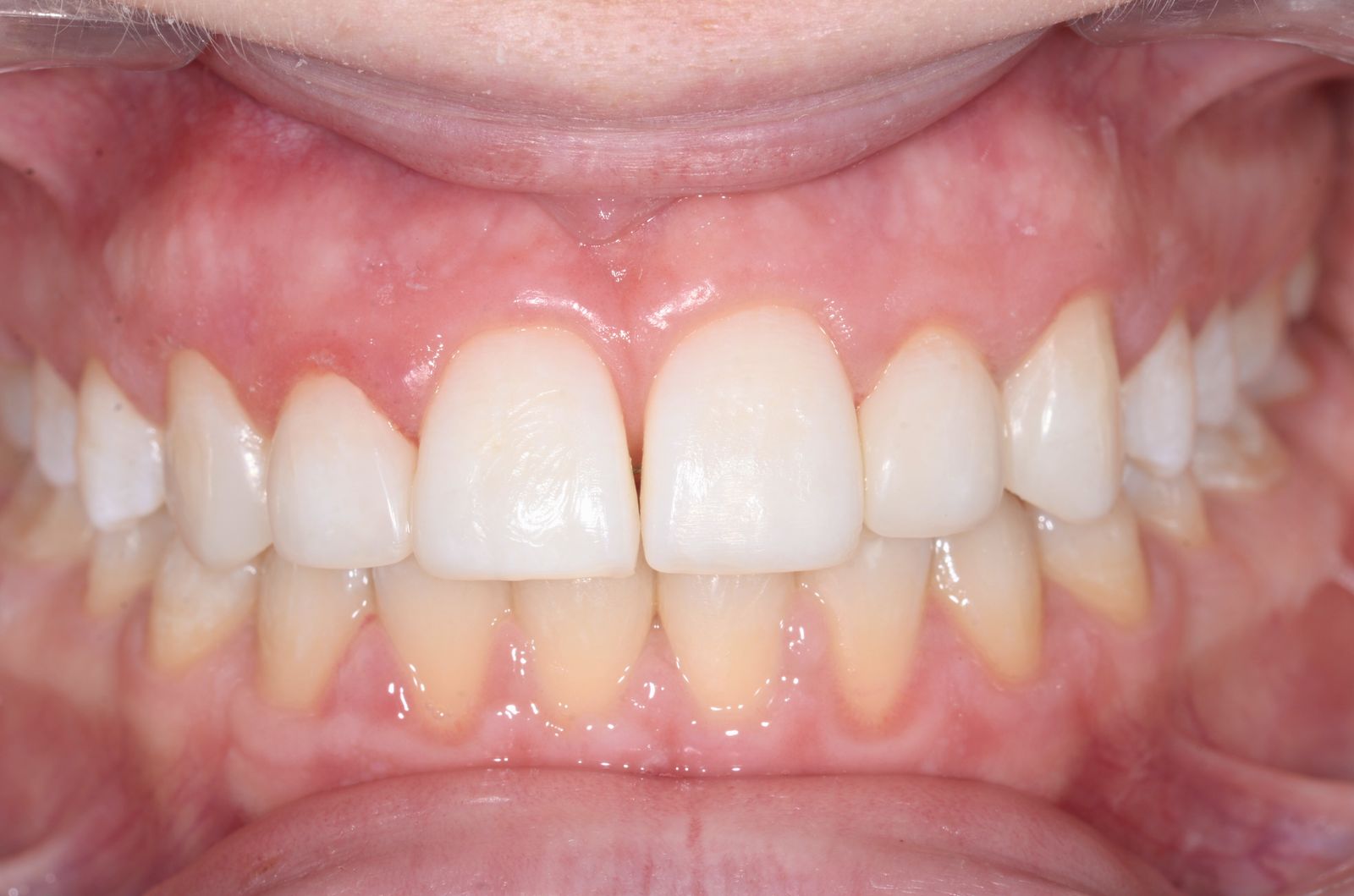 Breketai — atvejis 2