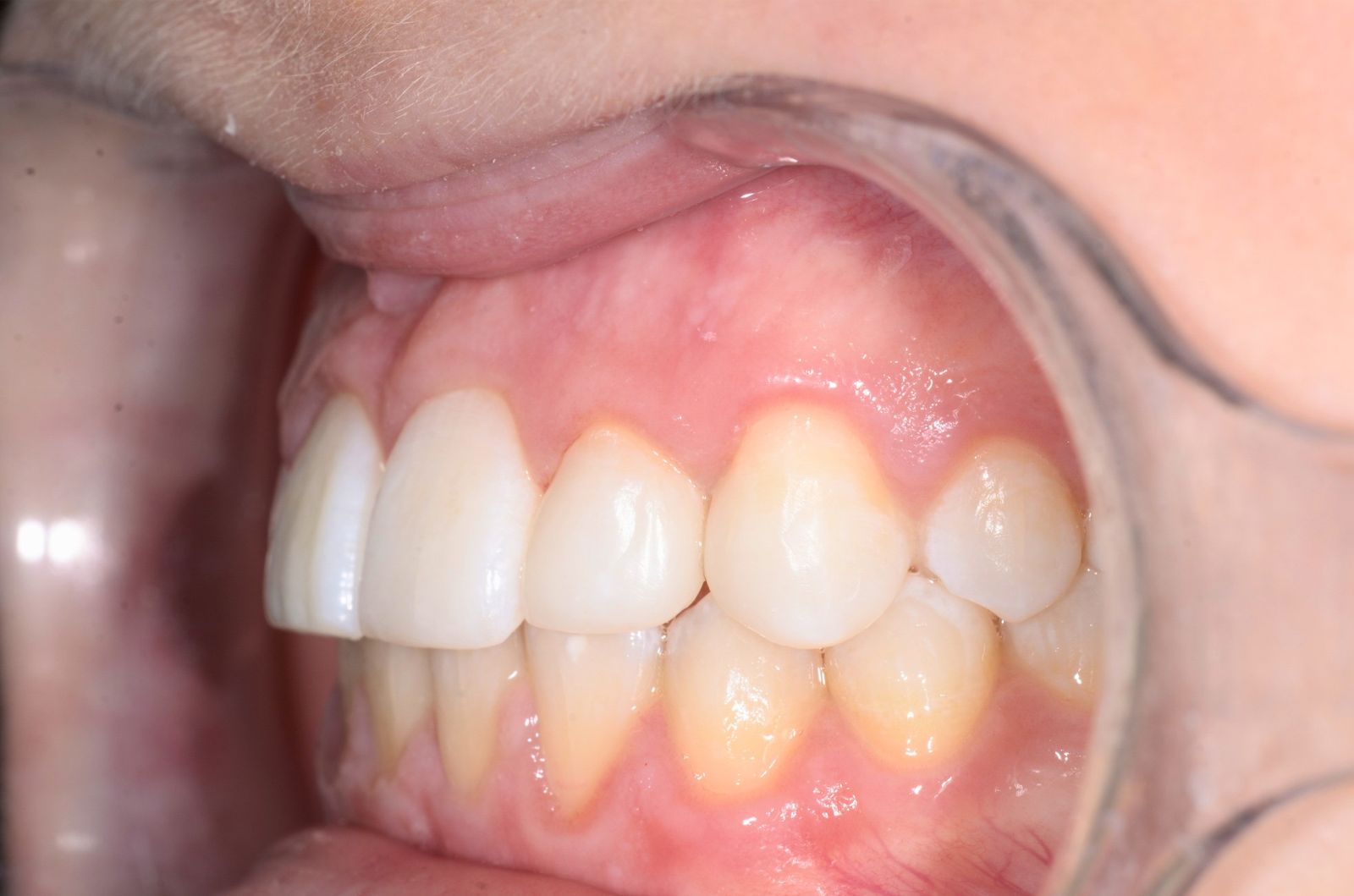 Breketai — atvejis 2