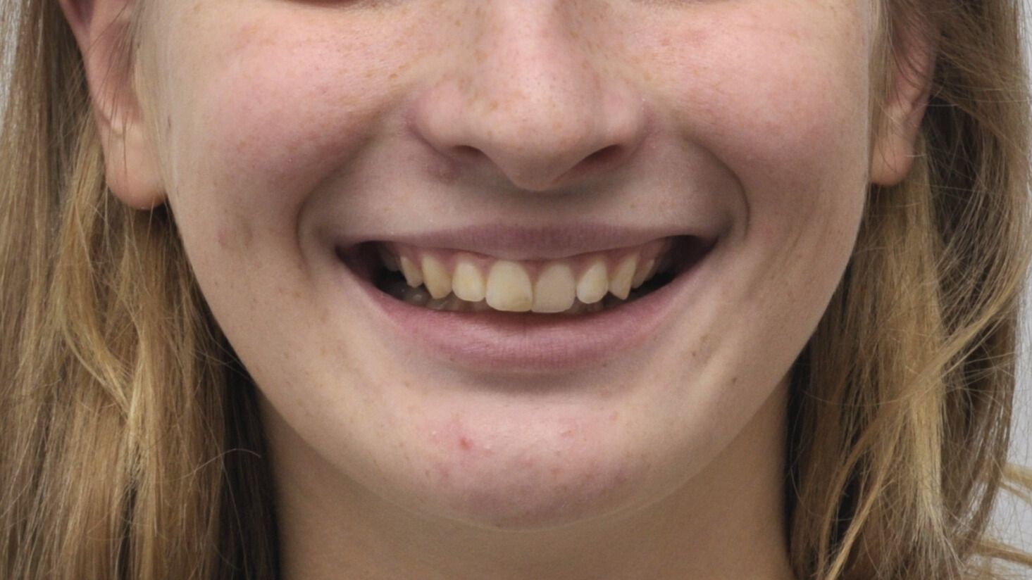 Breketai — atvejis 3