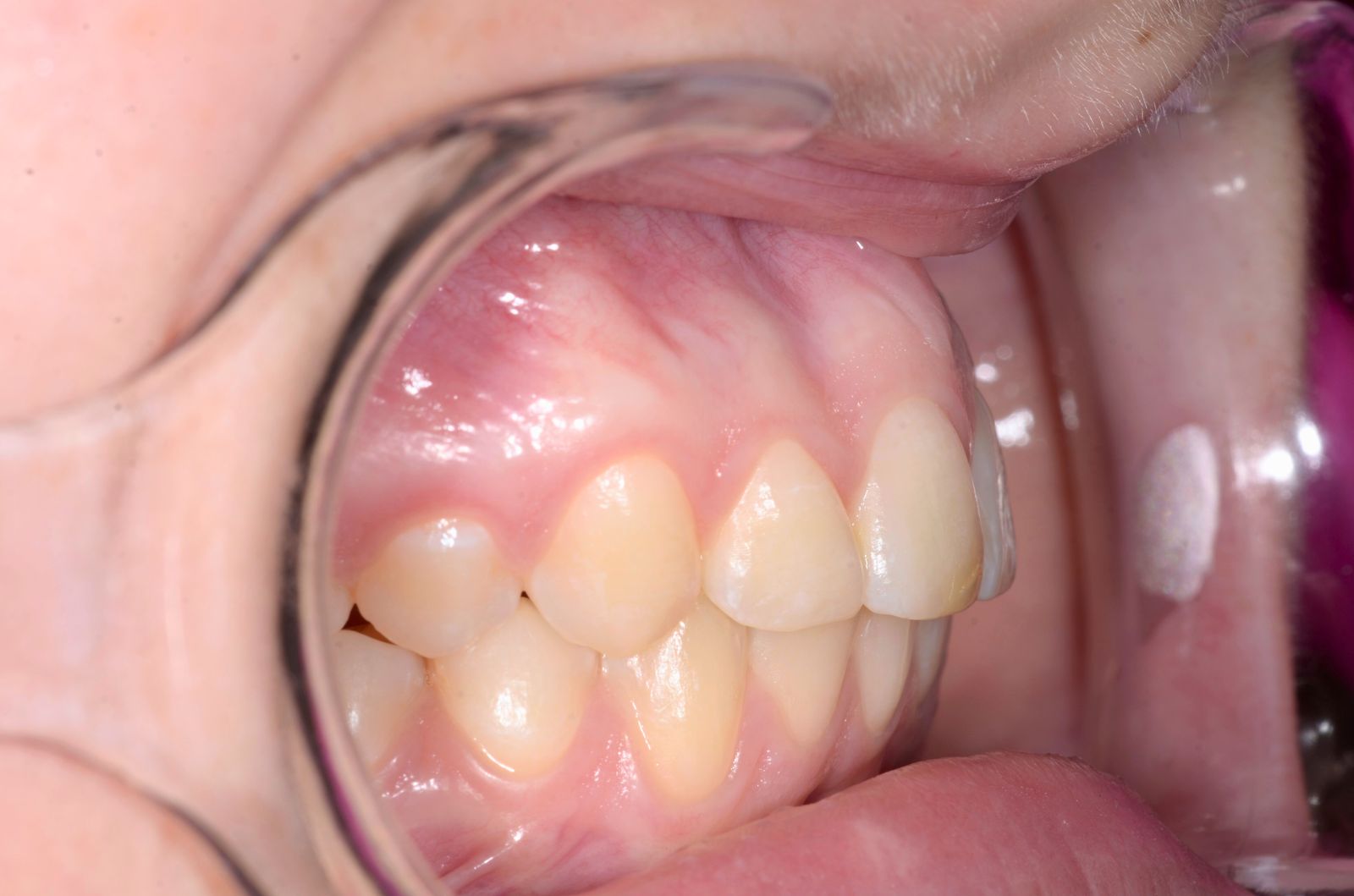 Breketai — atvejis 3