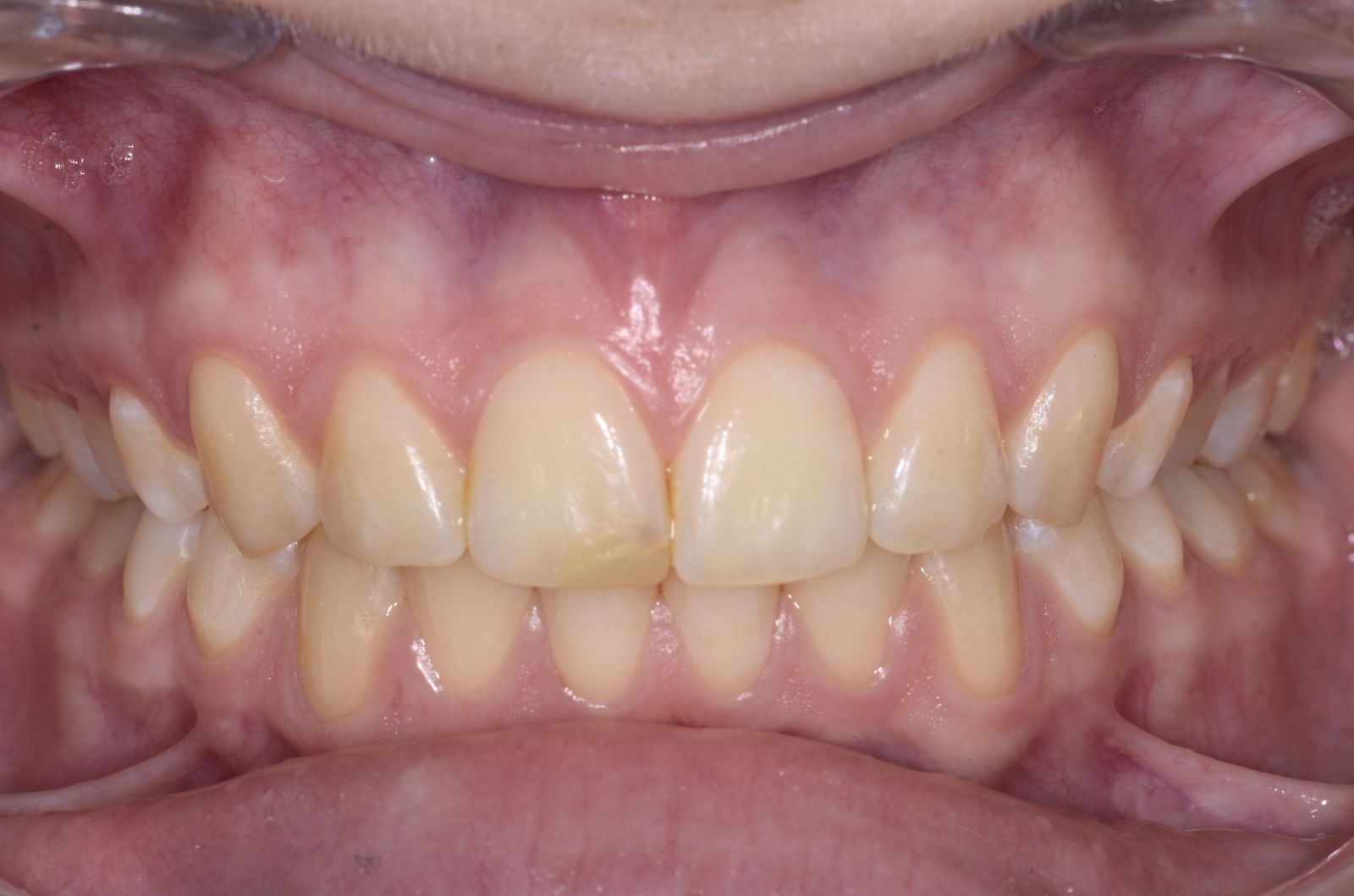 Breketai — atvejis 3