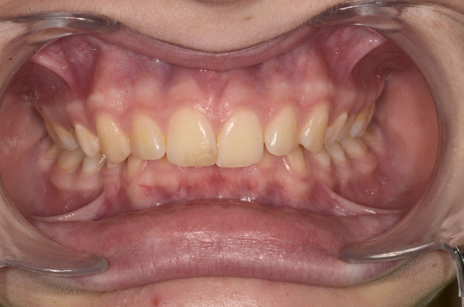 Breketai — atvejis 3