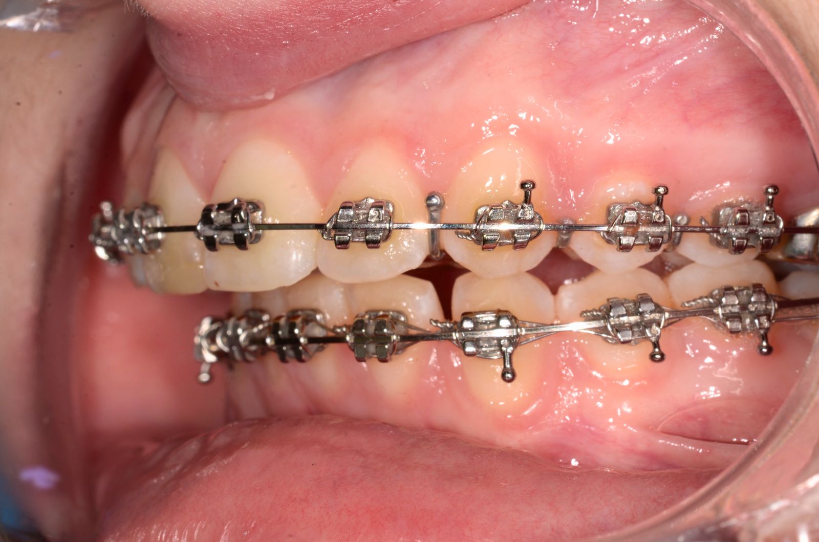 Breketai — atvejis 3