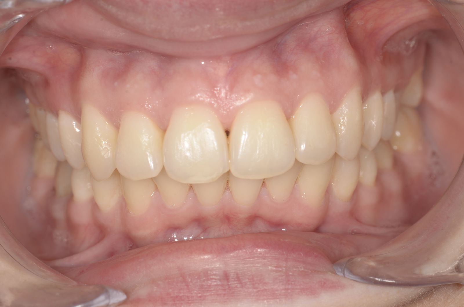 Breketai — atvejis 4