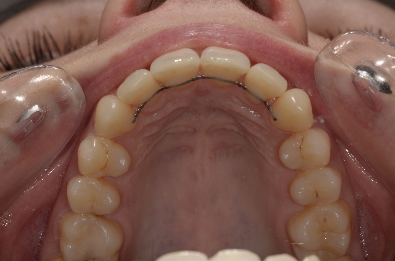 Breketai — atvejis 4