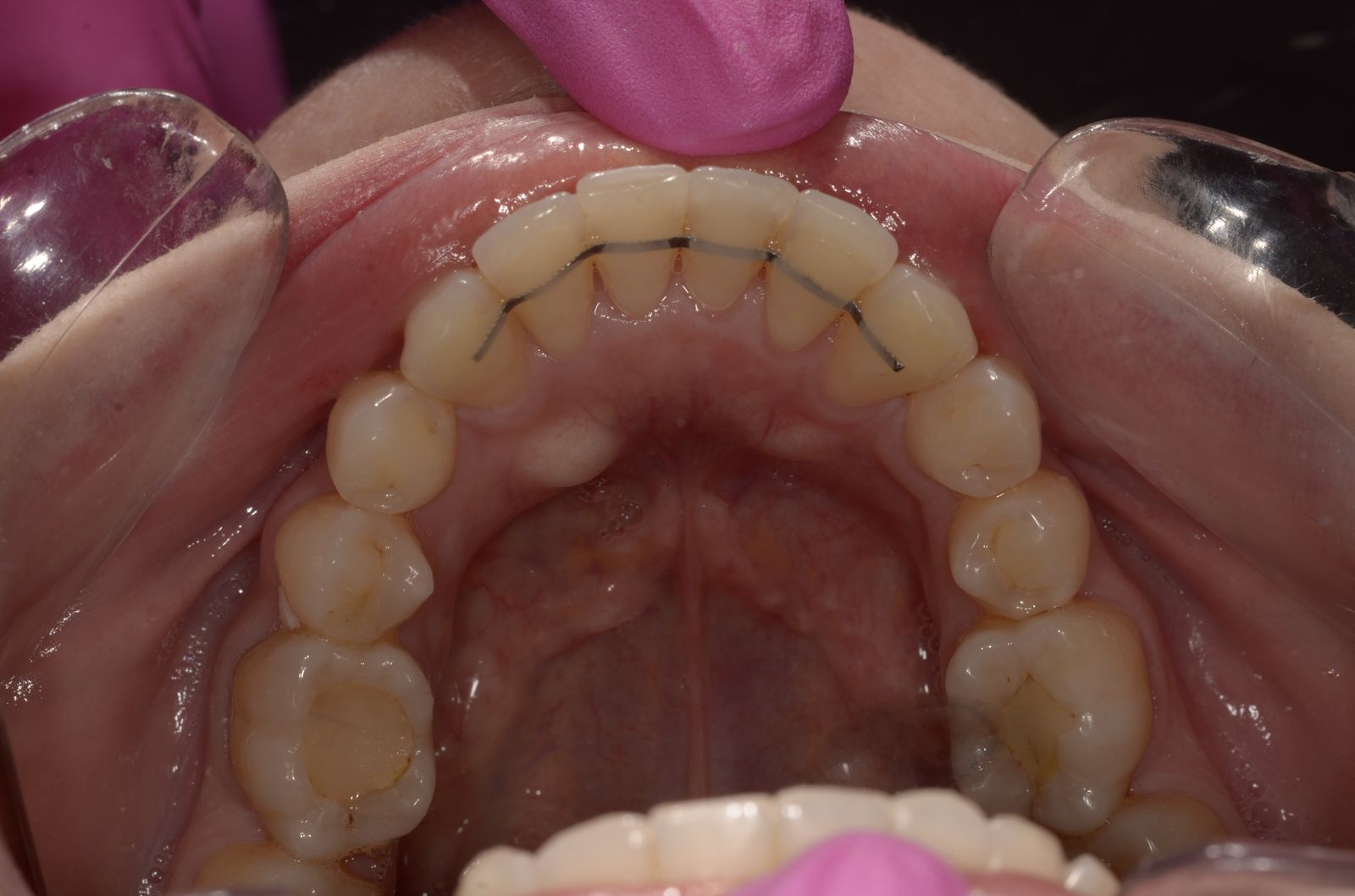 Breketai — atvejis 4