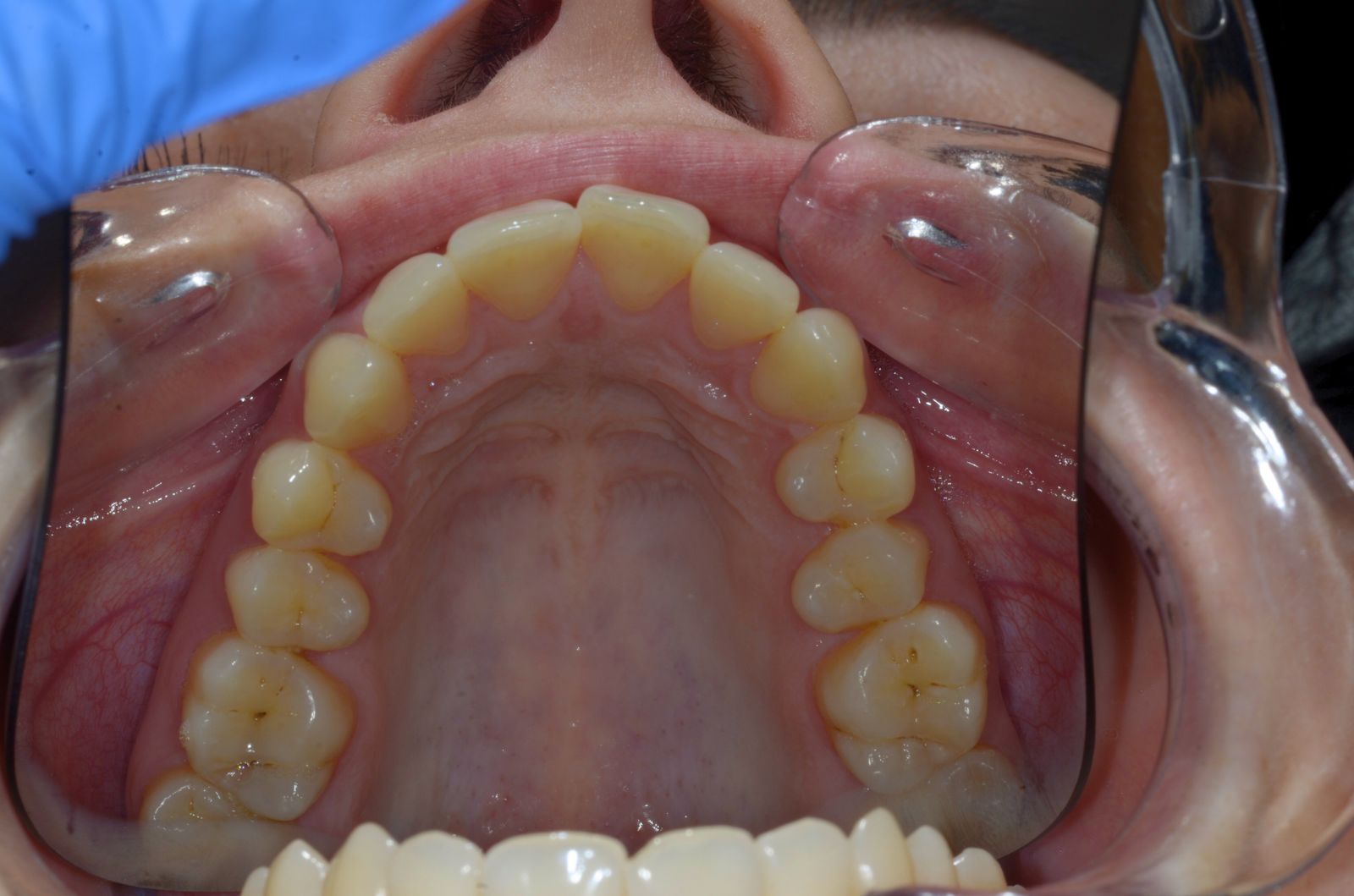 Breketai — atvejis 4