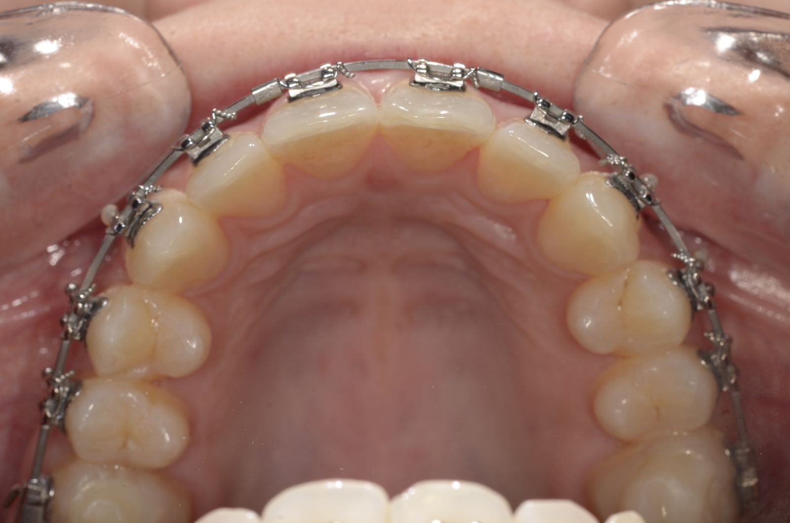 Breketai — atvejis 4