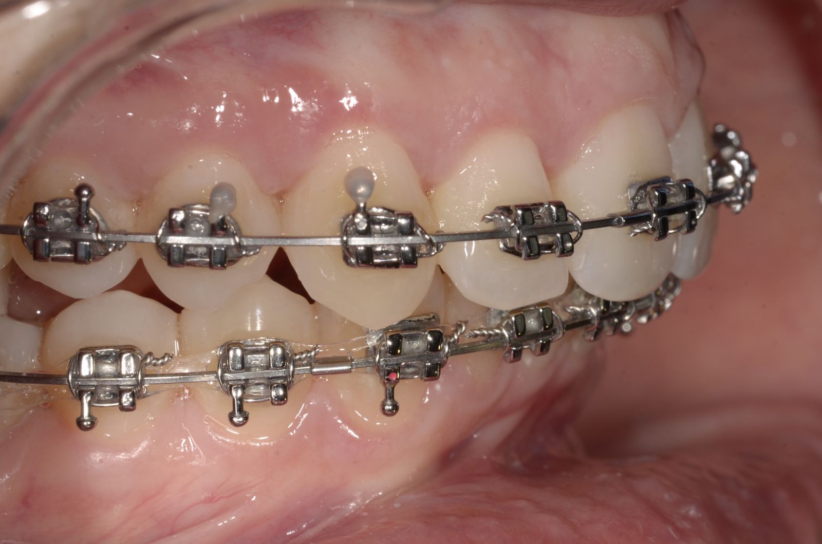 Breketai — atvejis 4