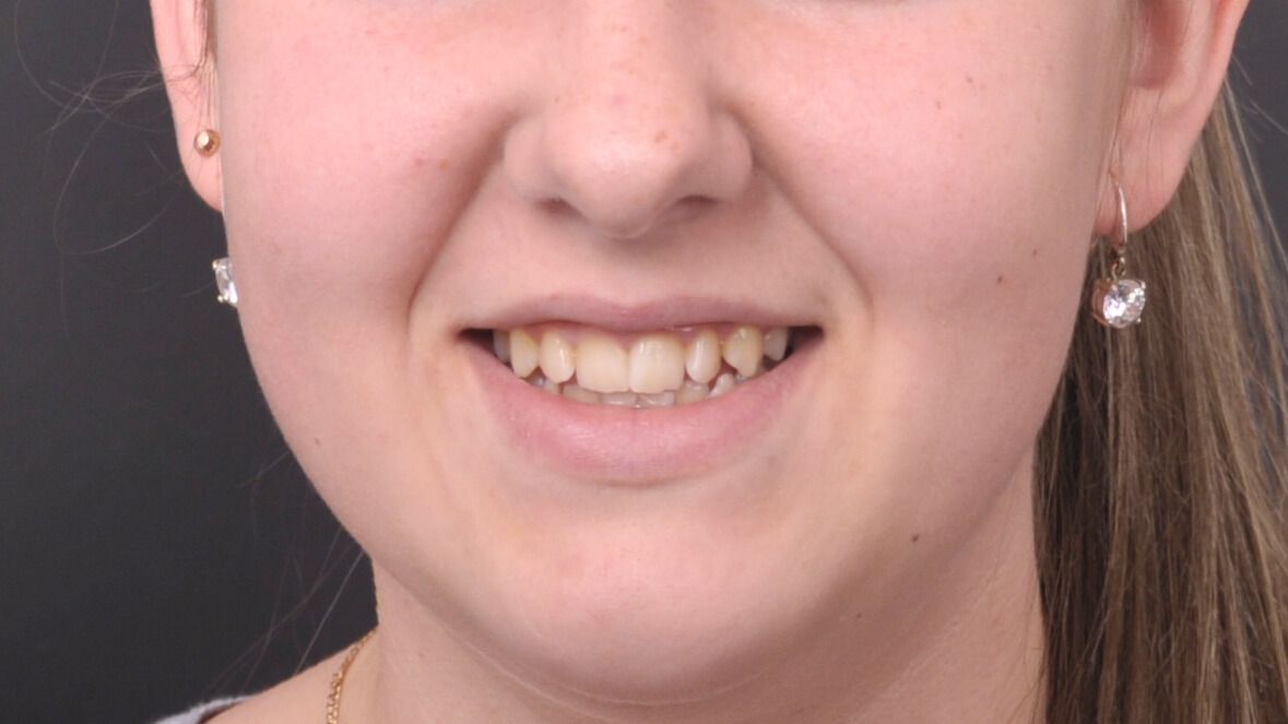 Breketai — atvejis 5