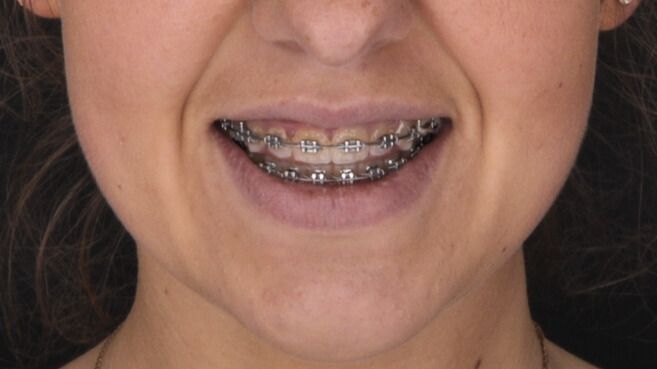 Breketai — atvejis 5