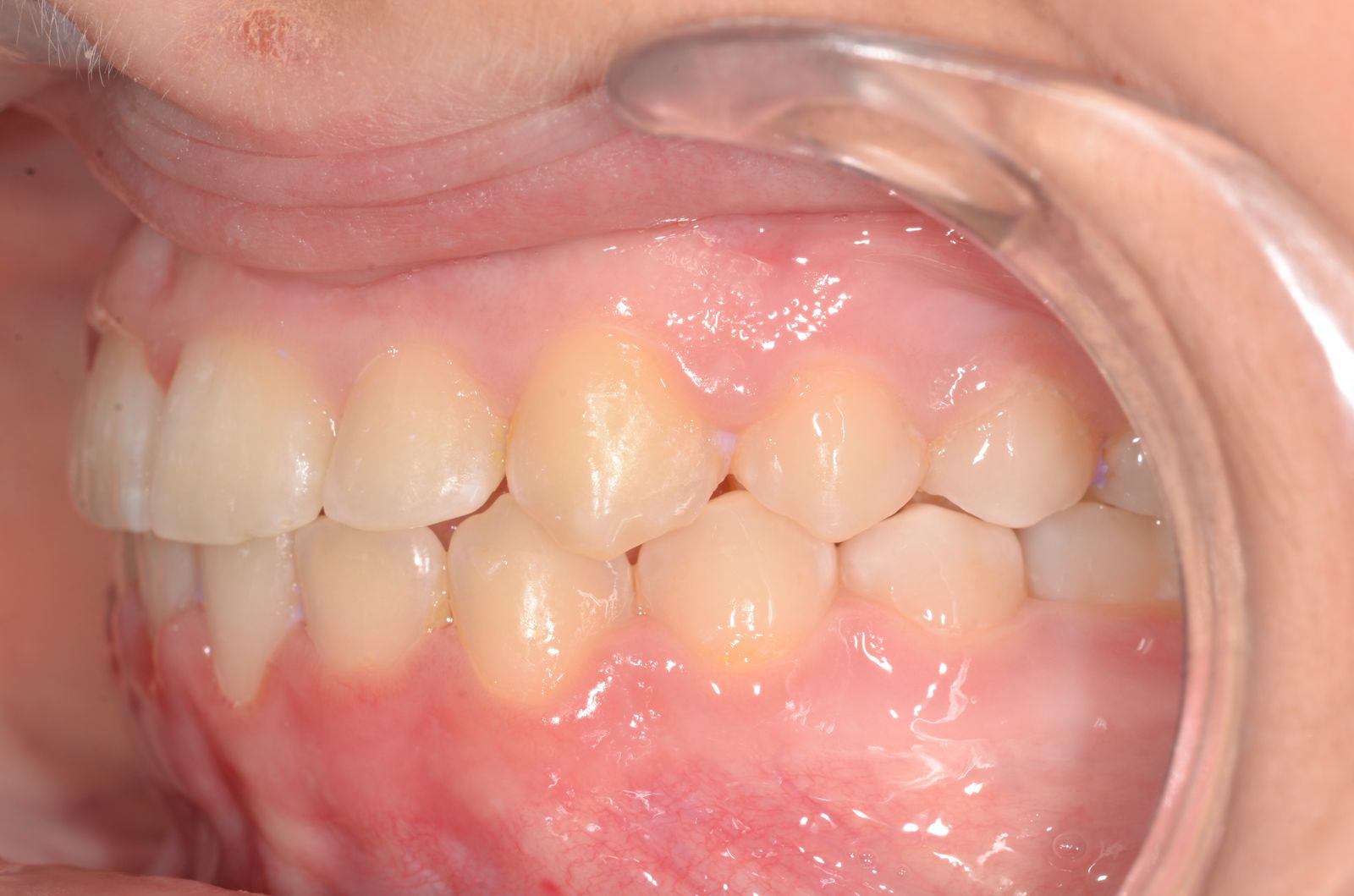 Breketai — atvejis 5