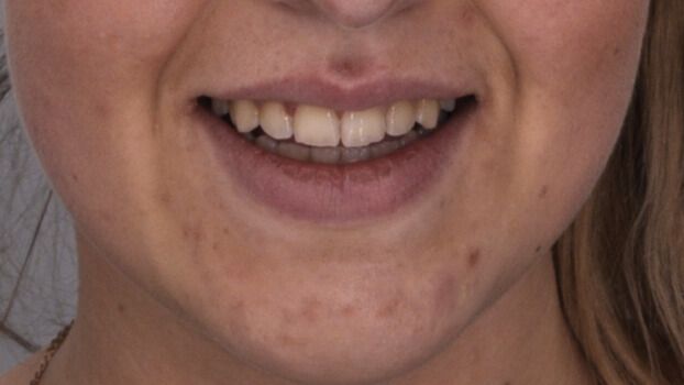 Breketai — atvejis 5