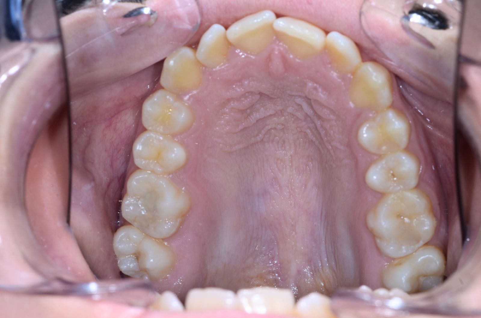 Breketai — atvejis 5