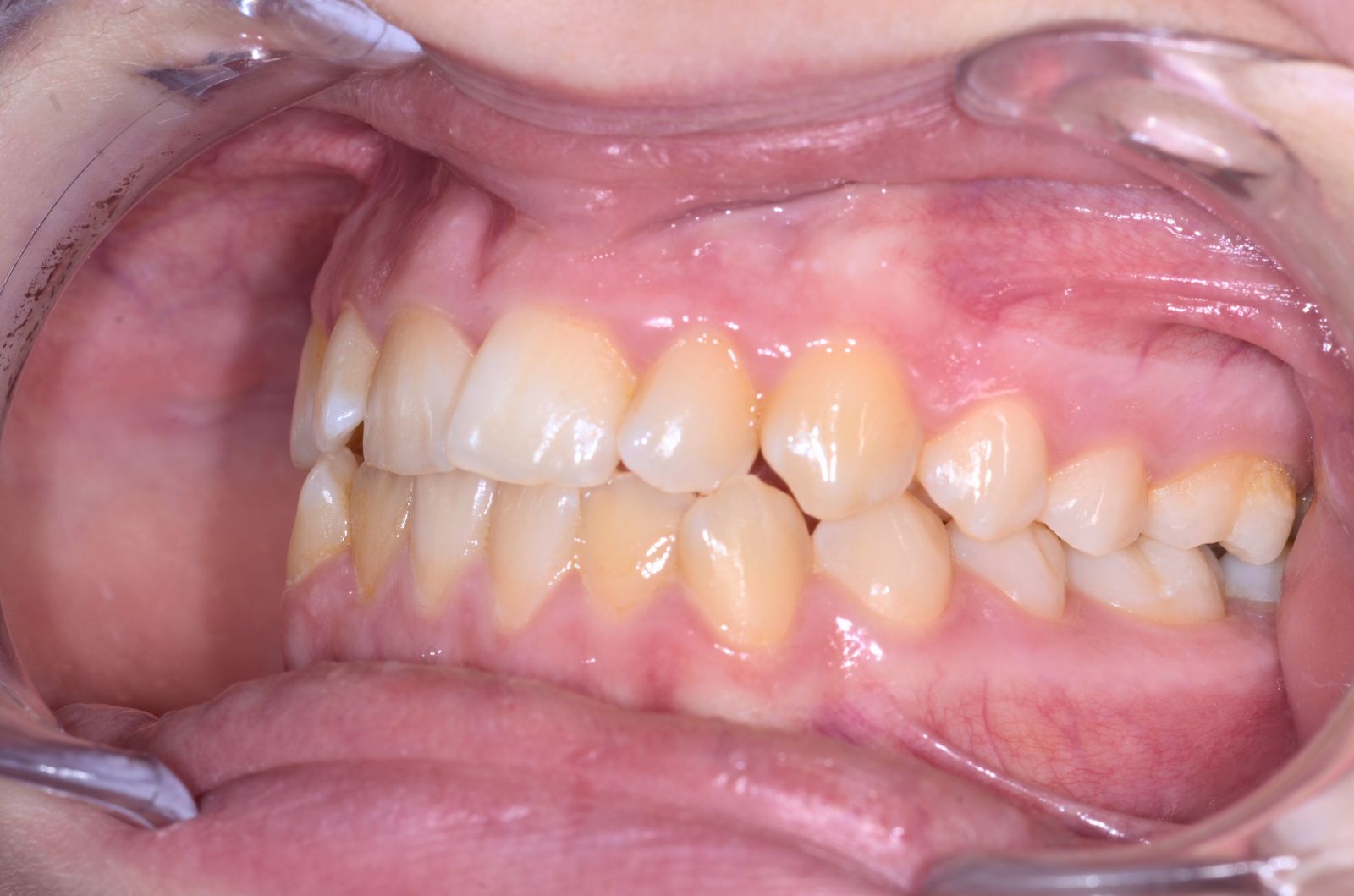 Breketai — atvejis 5