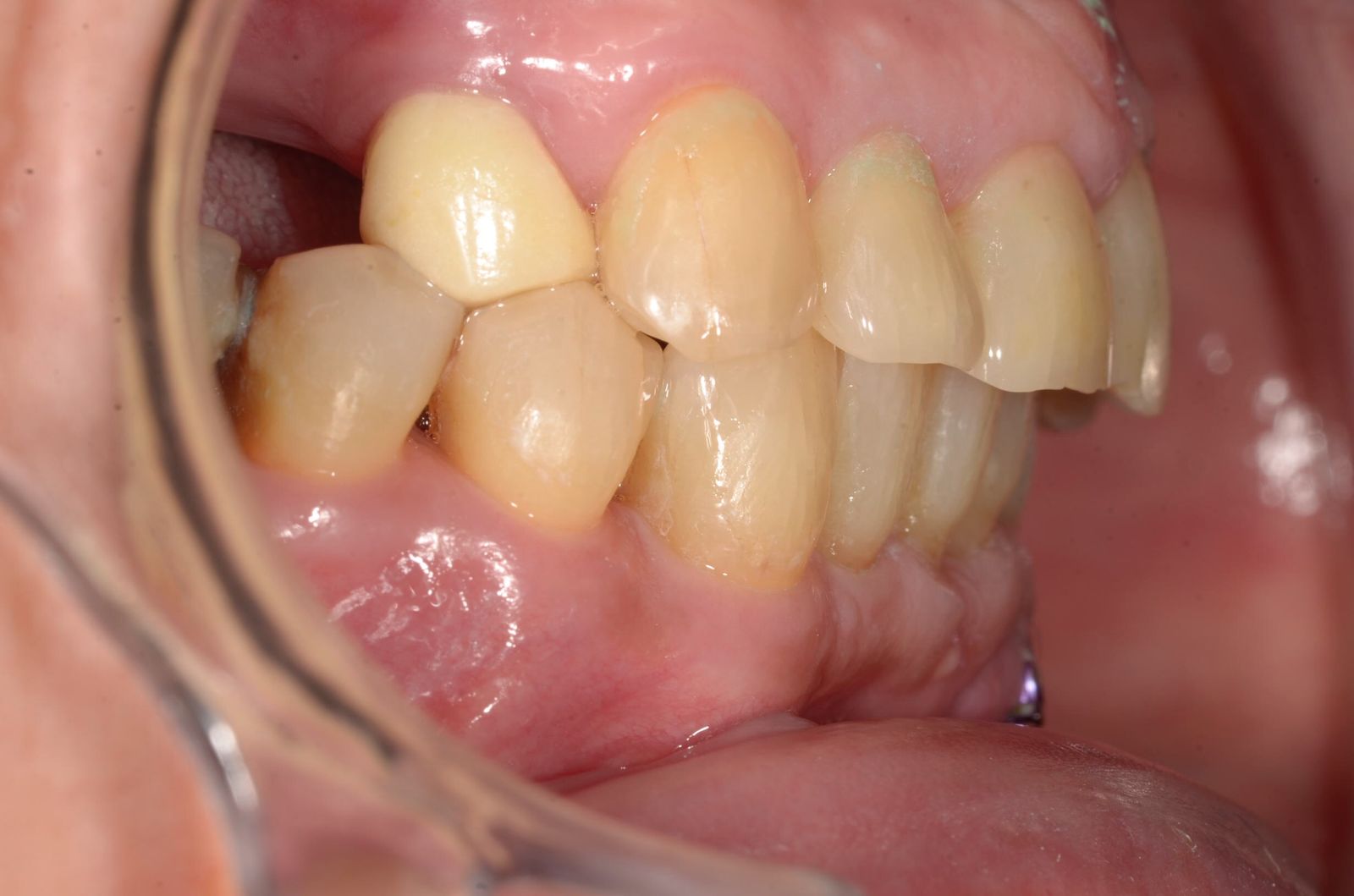 Breketai — atvejis 6