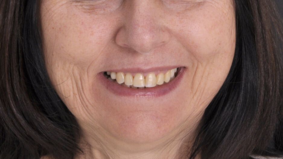 Breketai — atvejis 6