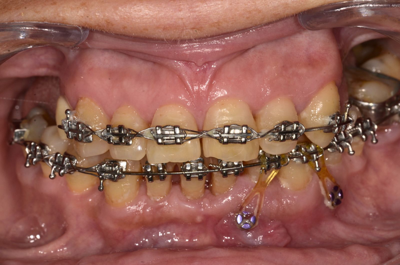 Breketai — atvejis 6