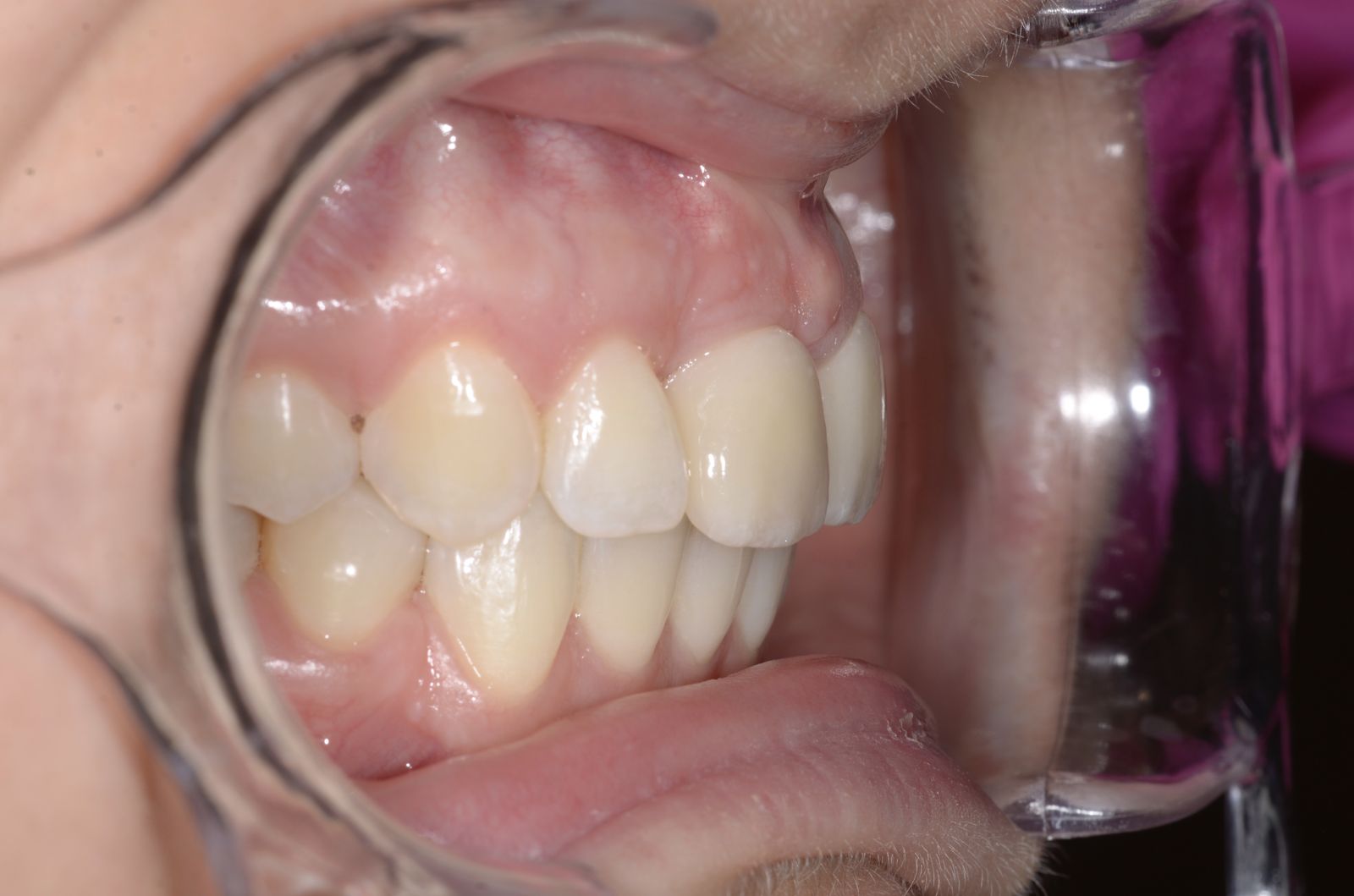 Breketai — atvejis 7