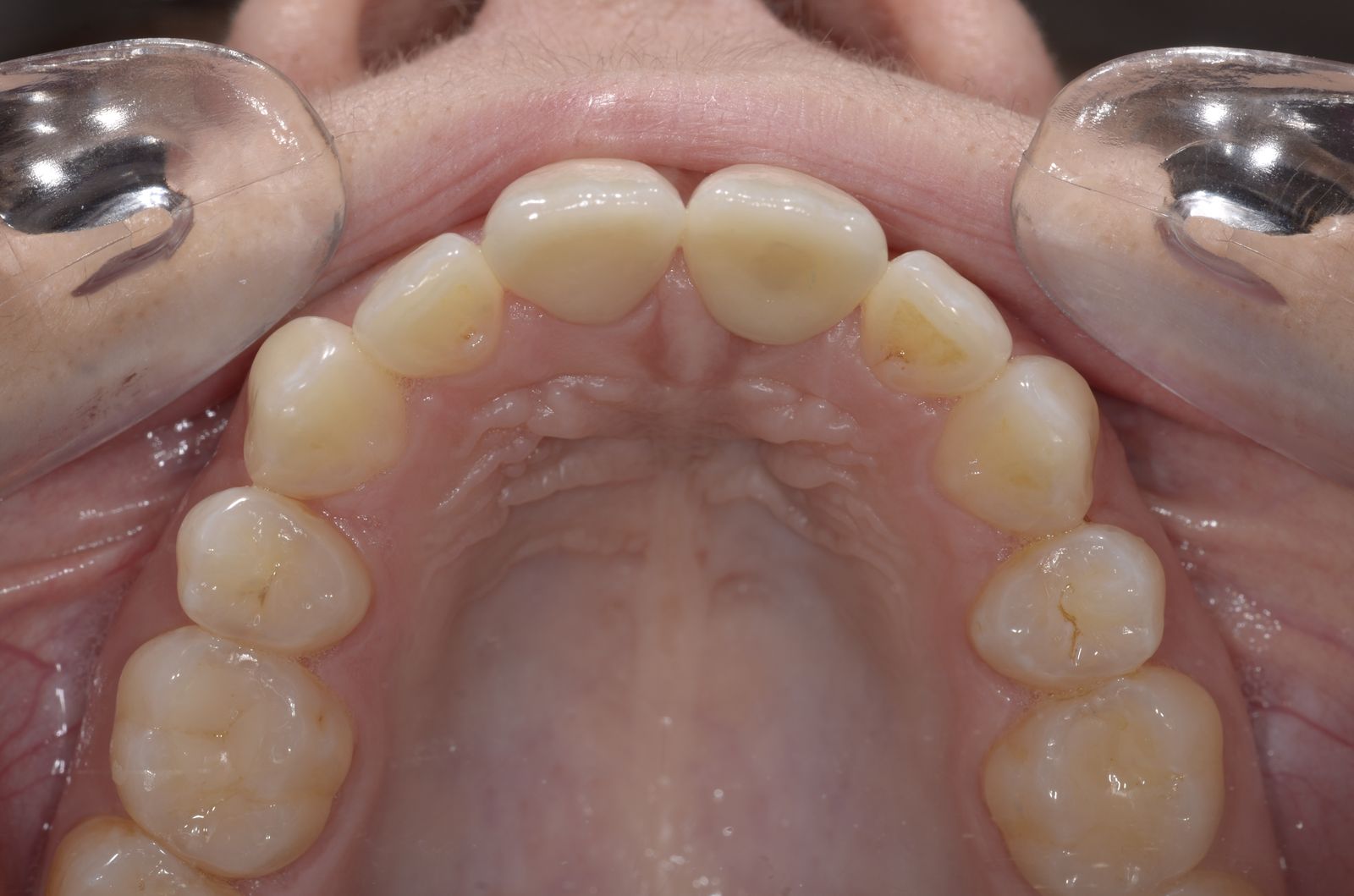 Breketai — atvejis 7