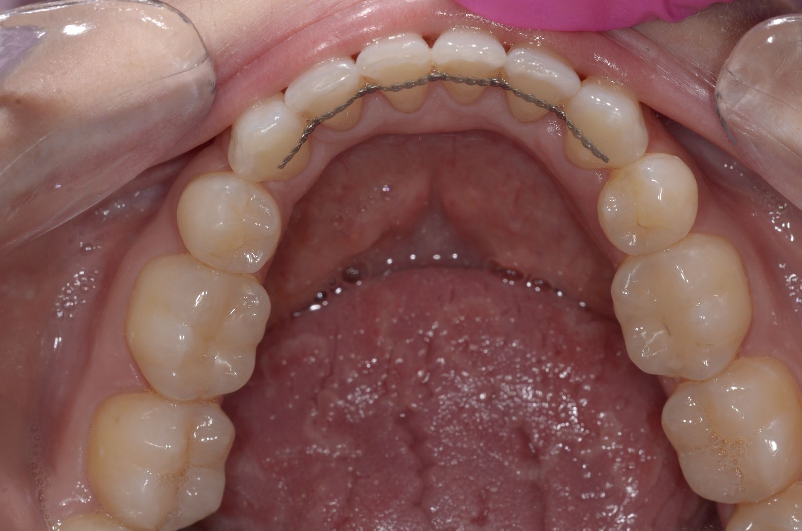 Breketai — atvejis 7