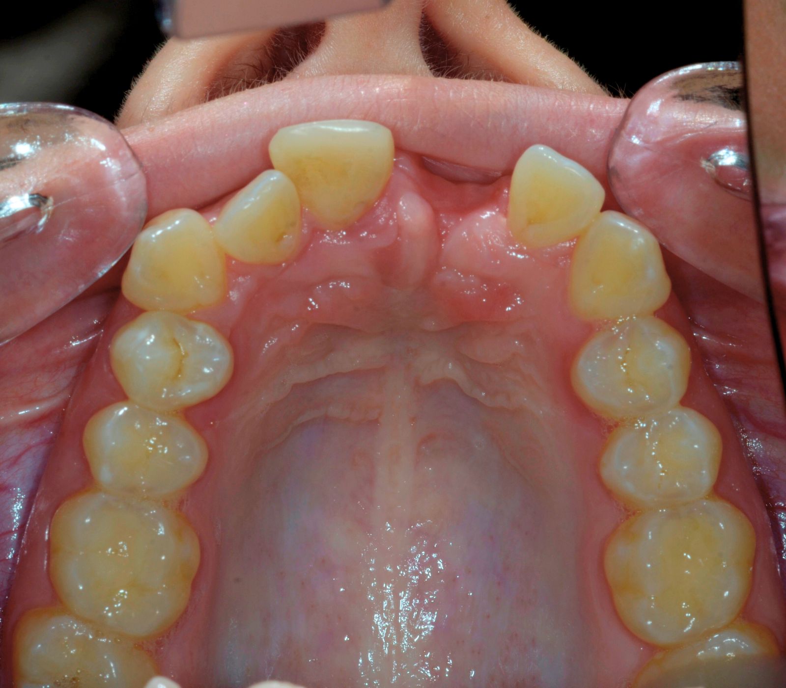 Breketai — atvejis 7