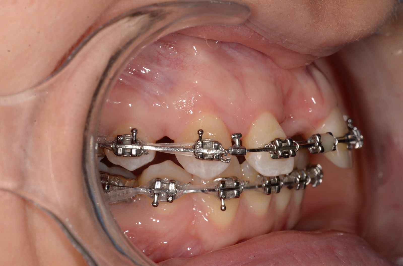 Breketai — atvejis 7