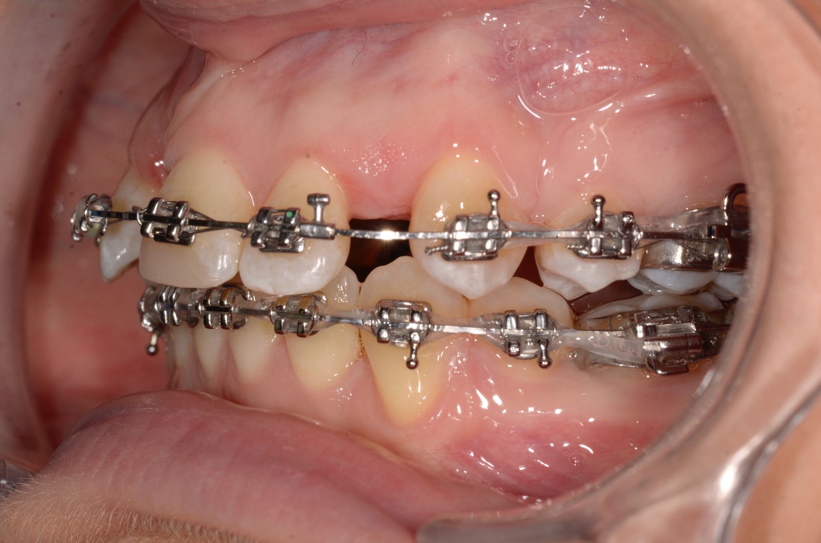 Breketai — atvejis 7