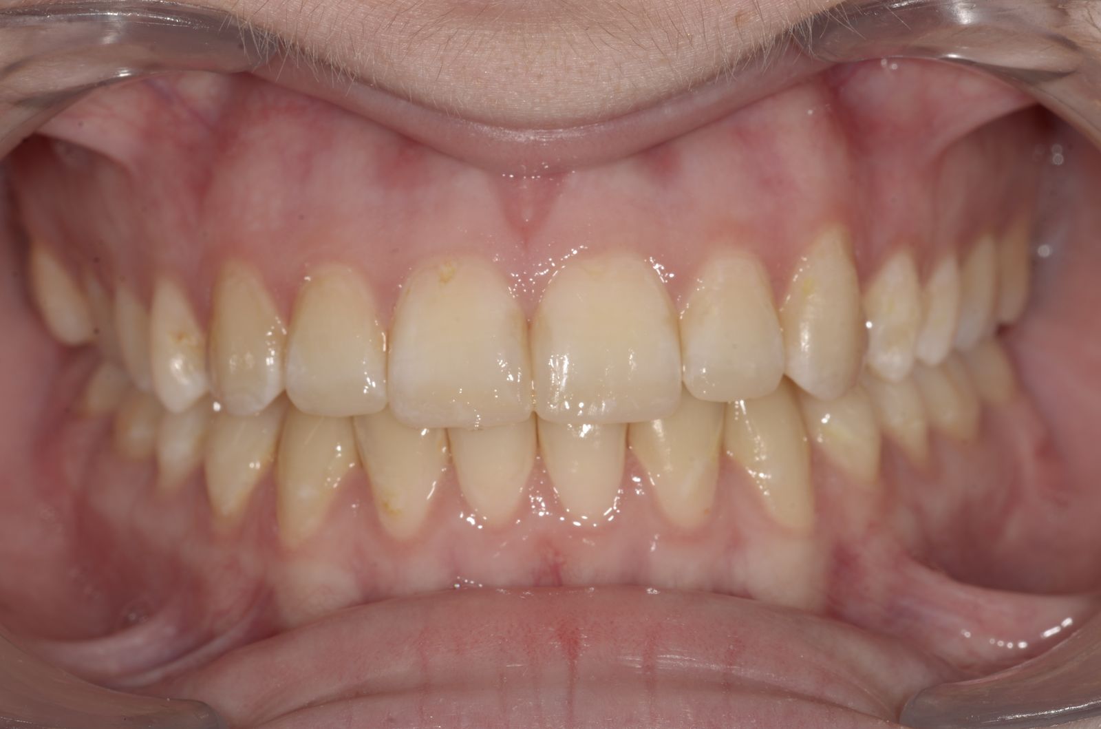 Breketai — atvejis 10