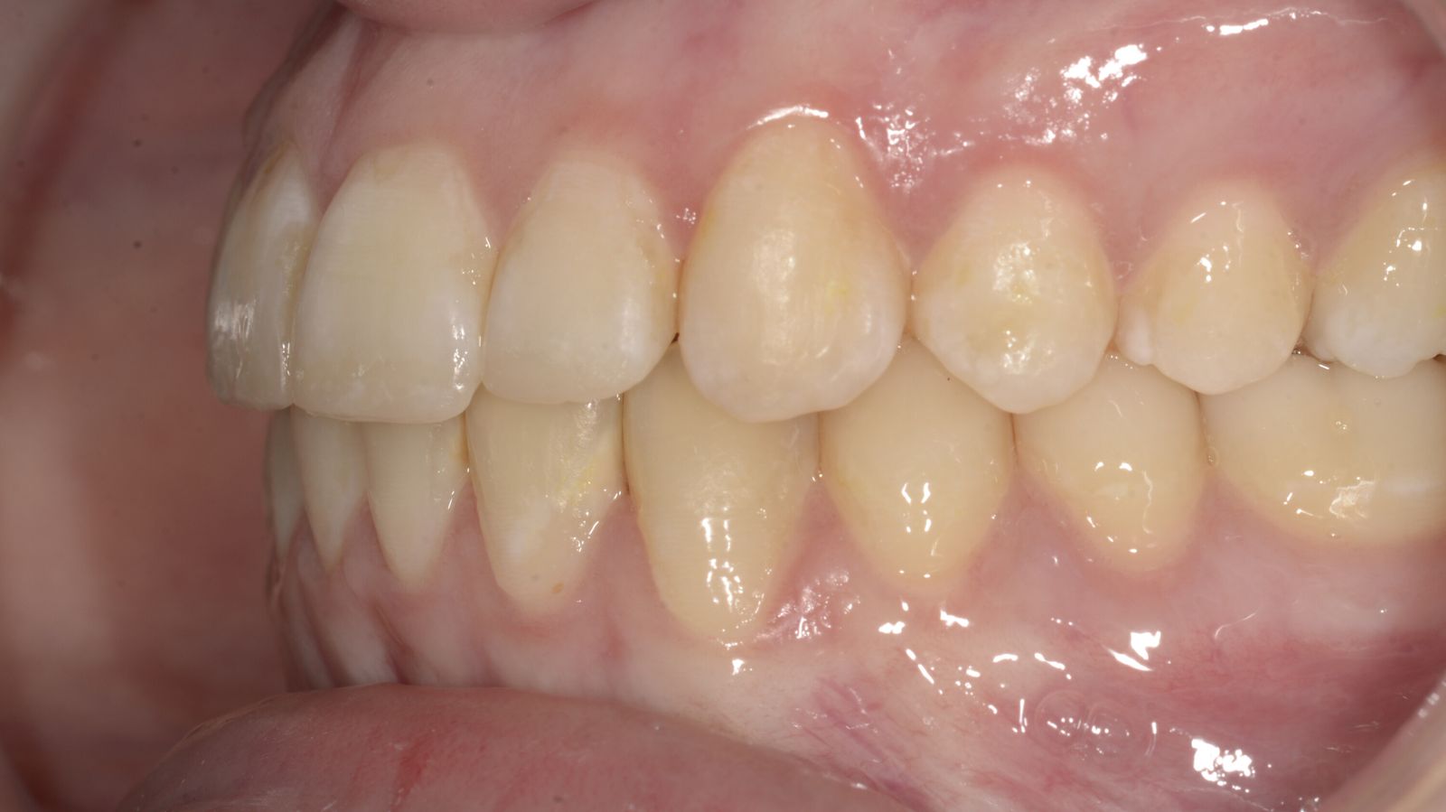 Breketai — atvejis 10