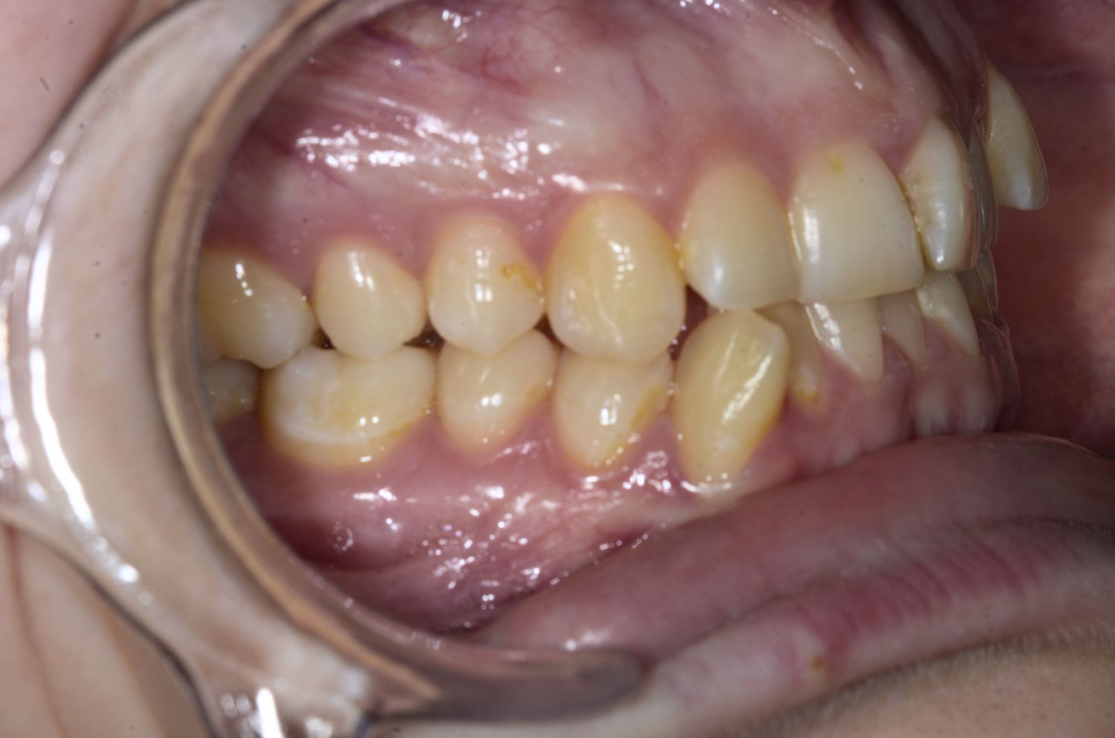 Breketai — atvejis 10